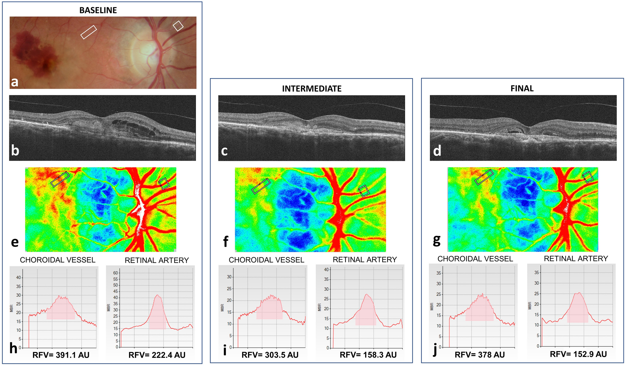 Short-term changes in retinal and choroidal relative flow volume after  anti-VEGF treatment for neovascular age-related macular degeneration |  Scientific Reports