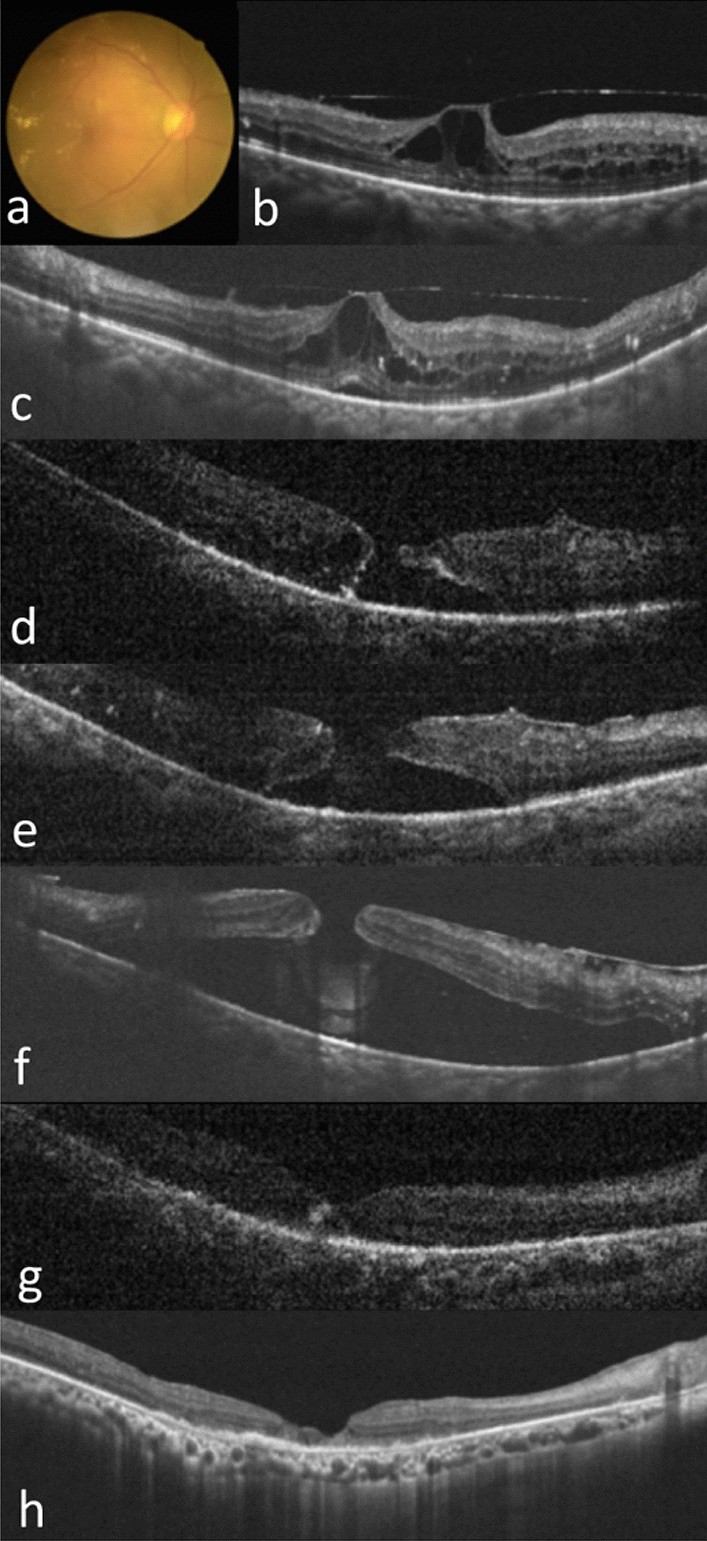 Full-thickness macular hole formation in proliferative diabetic retinopathy  | Scientific Reports