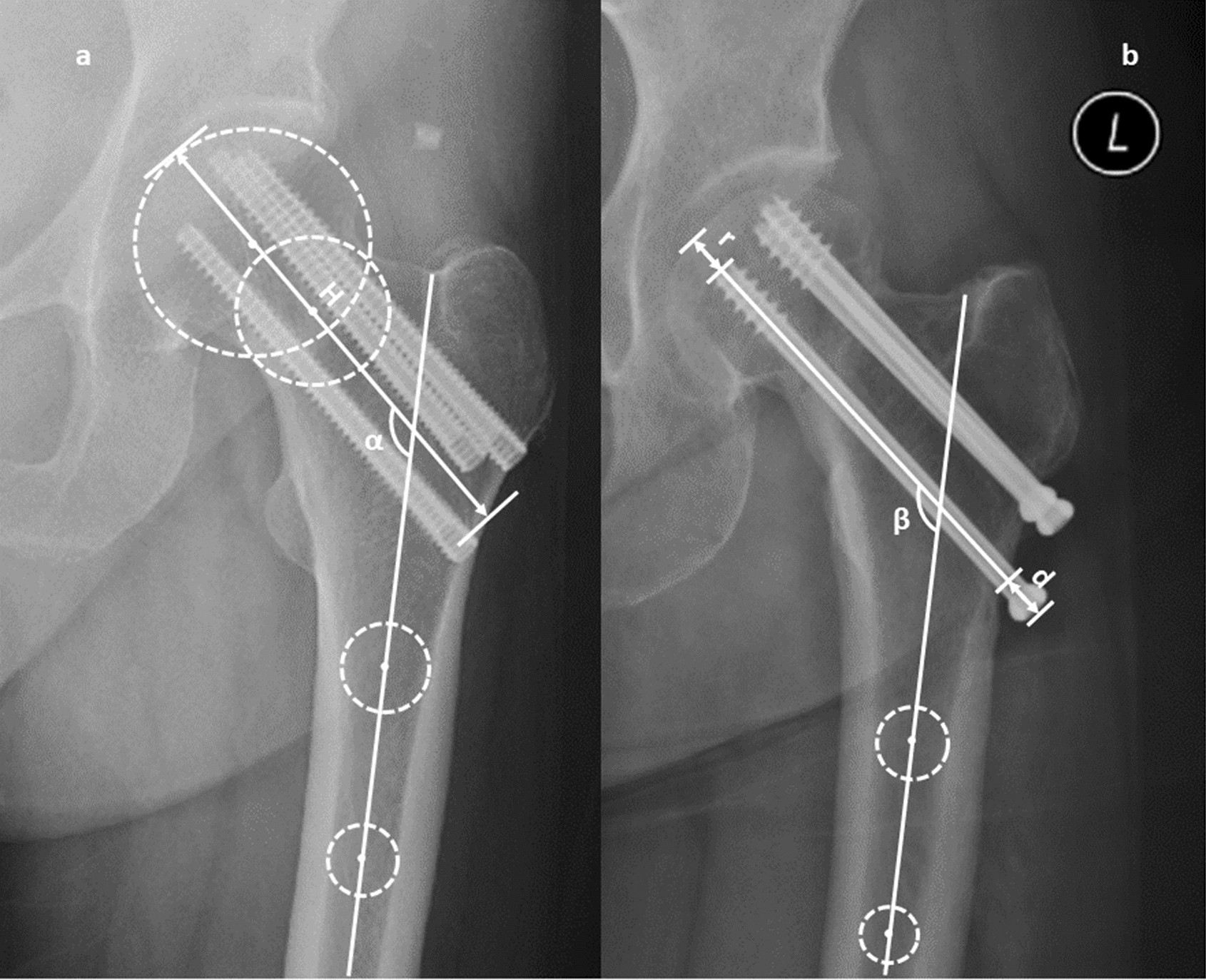 Comparison between headless cannulated screws and partially threaded screws  in femoral neck fracture treatment: a retrospective cohort study |  Scientific Reports