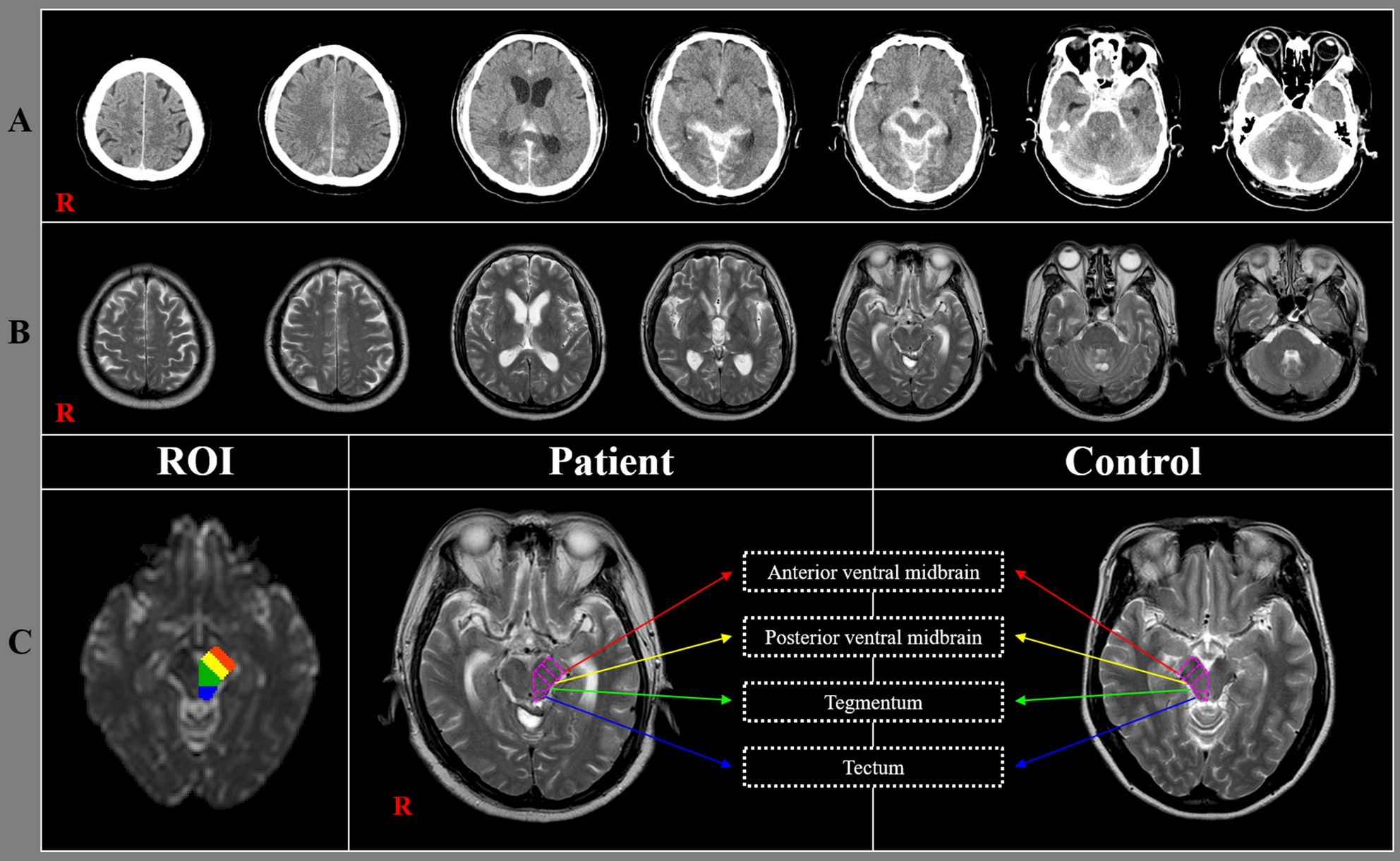 Midbrain injury in patients with subarachnoid hemorrhage: a diffusion  tensor imaging study | Scientific Reports