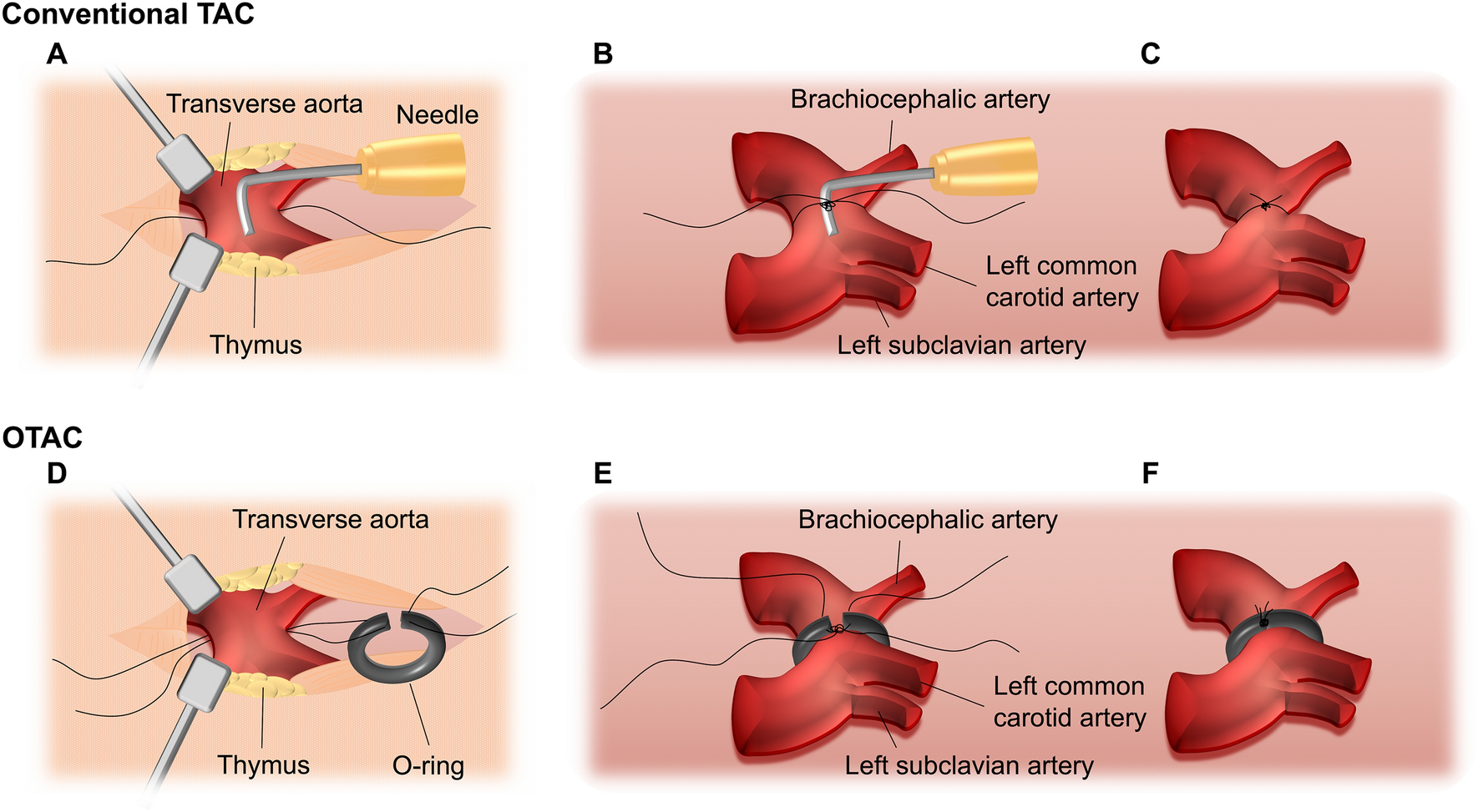 O-ring-induced transverse aortic constriction (OTAC) is a new simple method  to develop cardiac hypertrophy and heart failure in mice