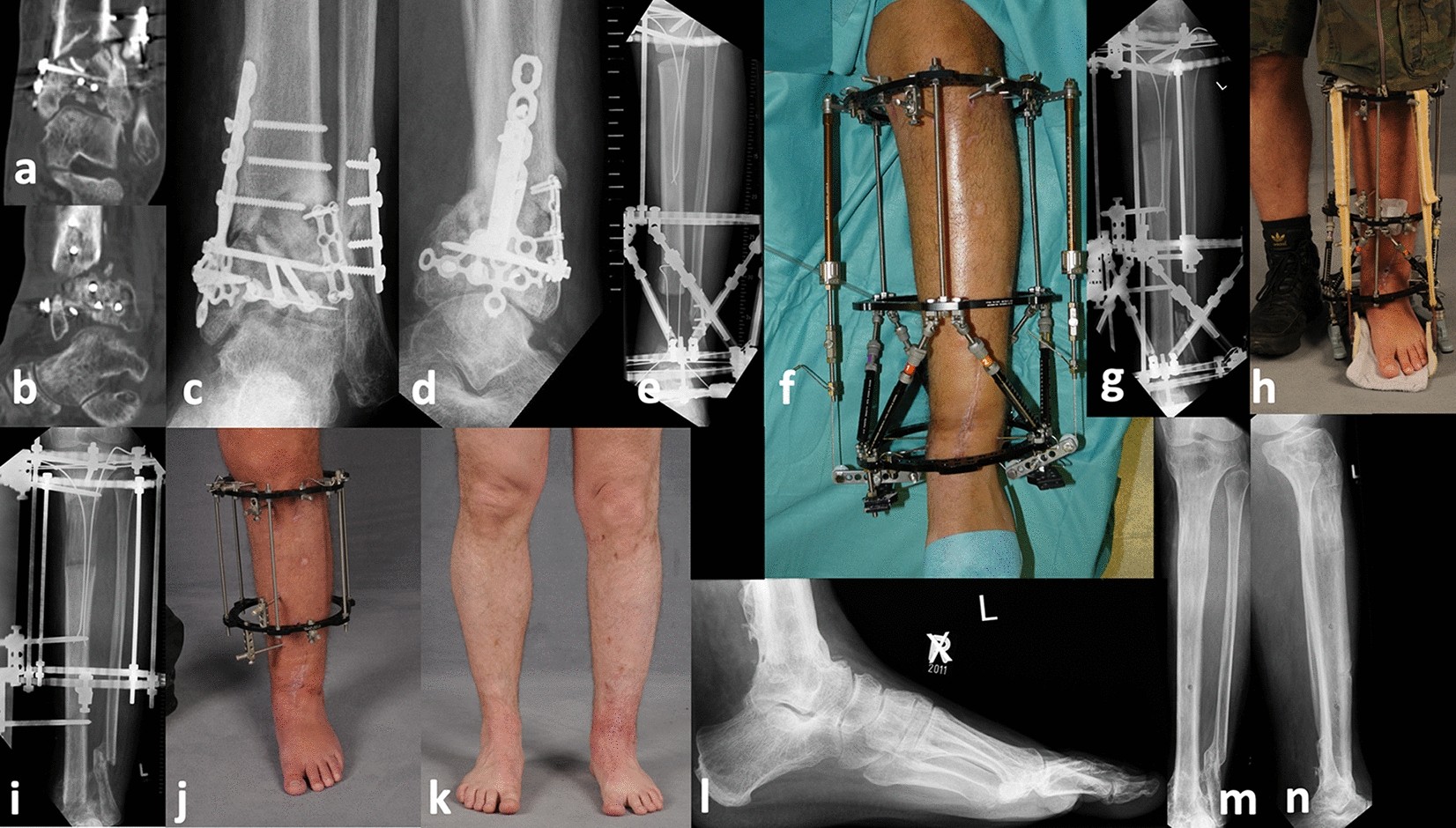 Ring external fixator (definitive) for Complete articular fracture