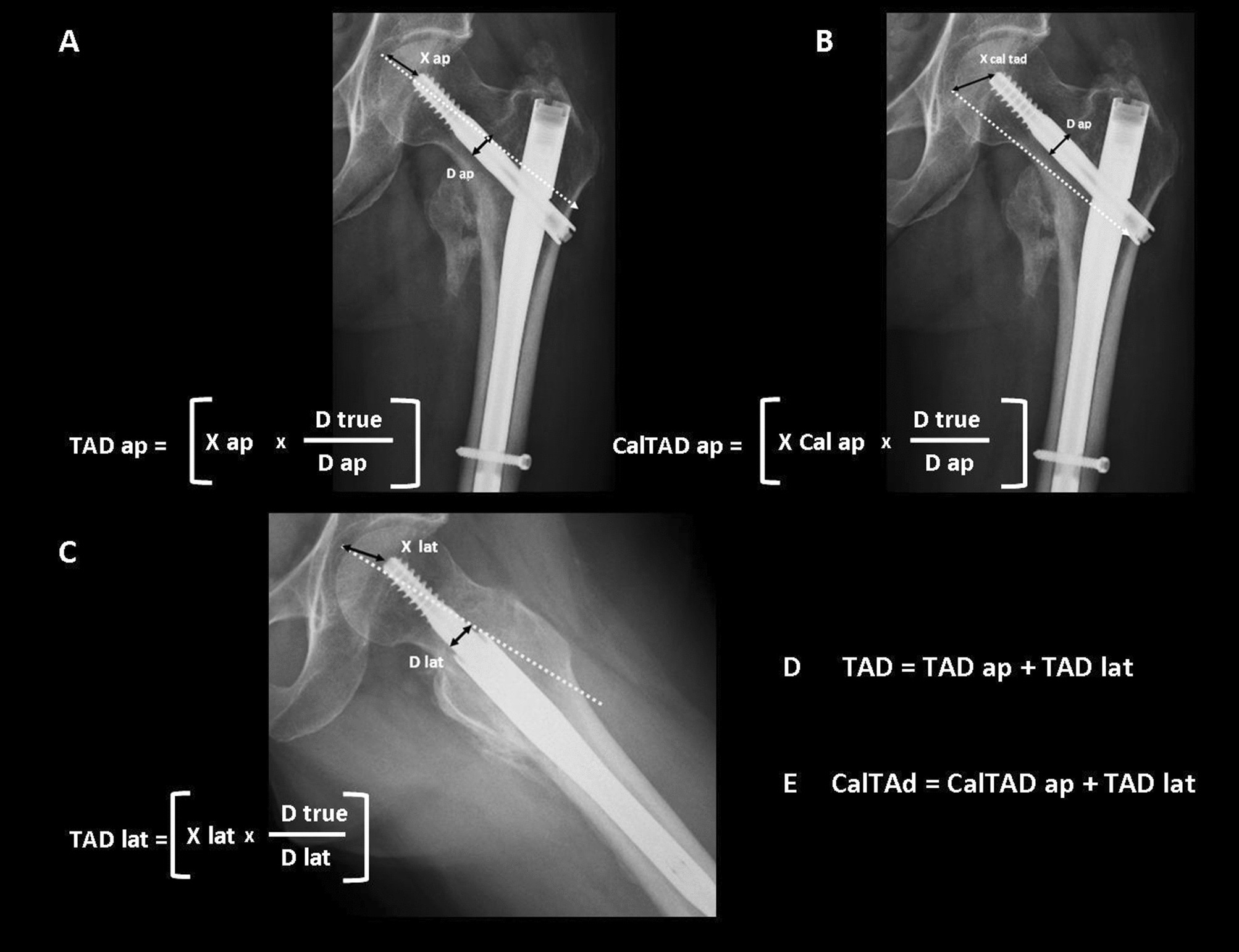 New tip-apex distance and calcar-referenced tip-apex distance cut-offs may be the best predictors for cut-out risk after intramedullary fixation of proximal femur fractures | Scientific Reports New tip-apex distance and calcar-referenced tip-apex distance cut-offs may be the best predictors for cut-out risk after intramedullary fixation of proximal femur fractures | Scientific Reports