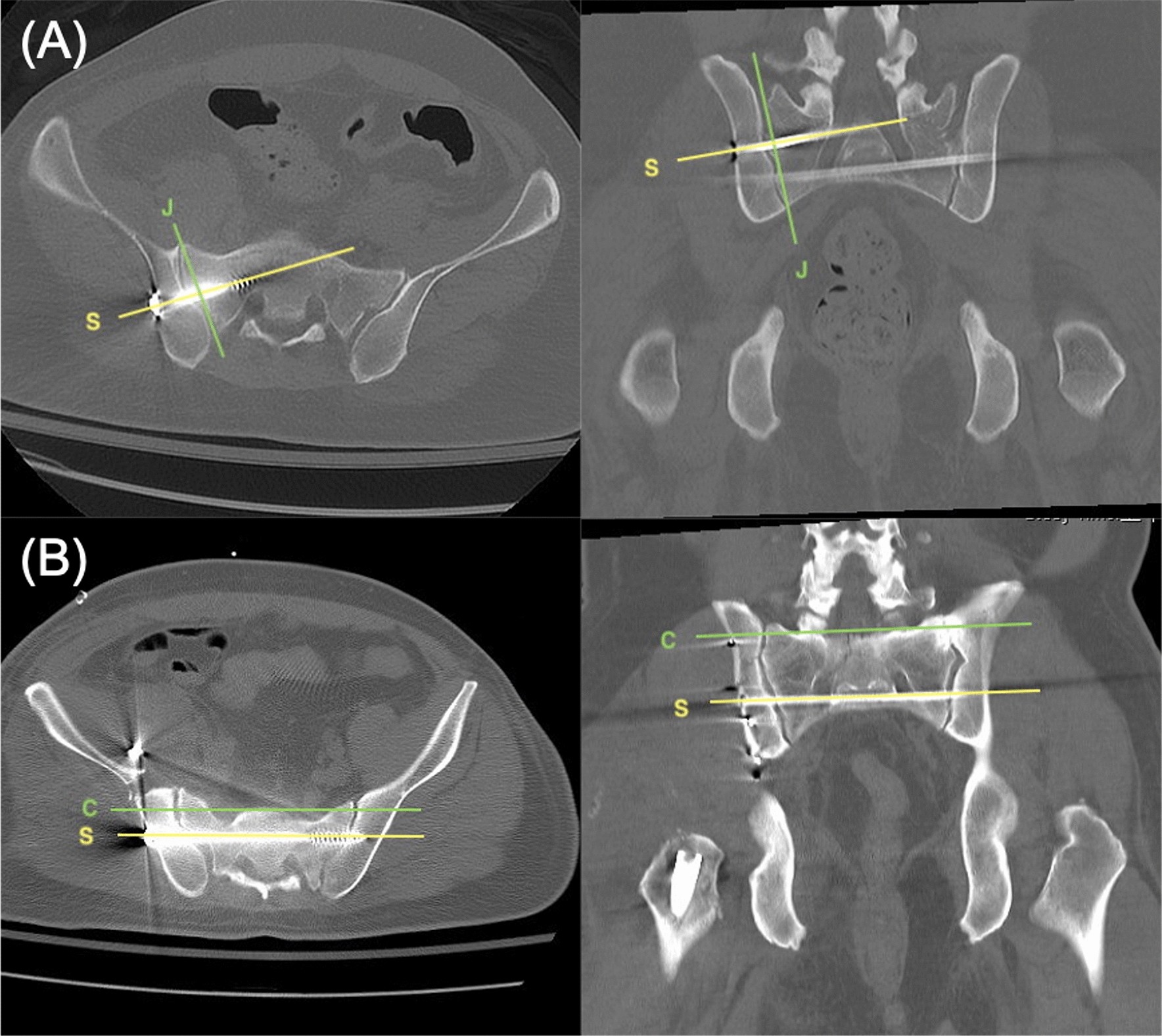 sætte ild Tag fat Hændelse Percutaneous iliosacral screw and trans-iliac trans-sacral screw with  single C-arm fluoroscope intensifier is a safe treatment for pelvic ring  injuries | Scientific Reports