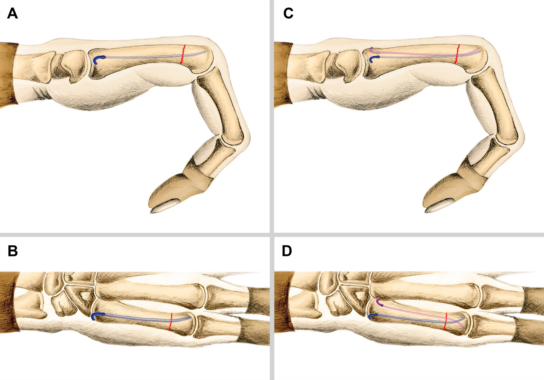 Techniques for Intramedullary Nailing of Proximal Tibia Fractures
