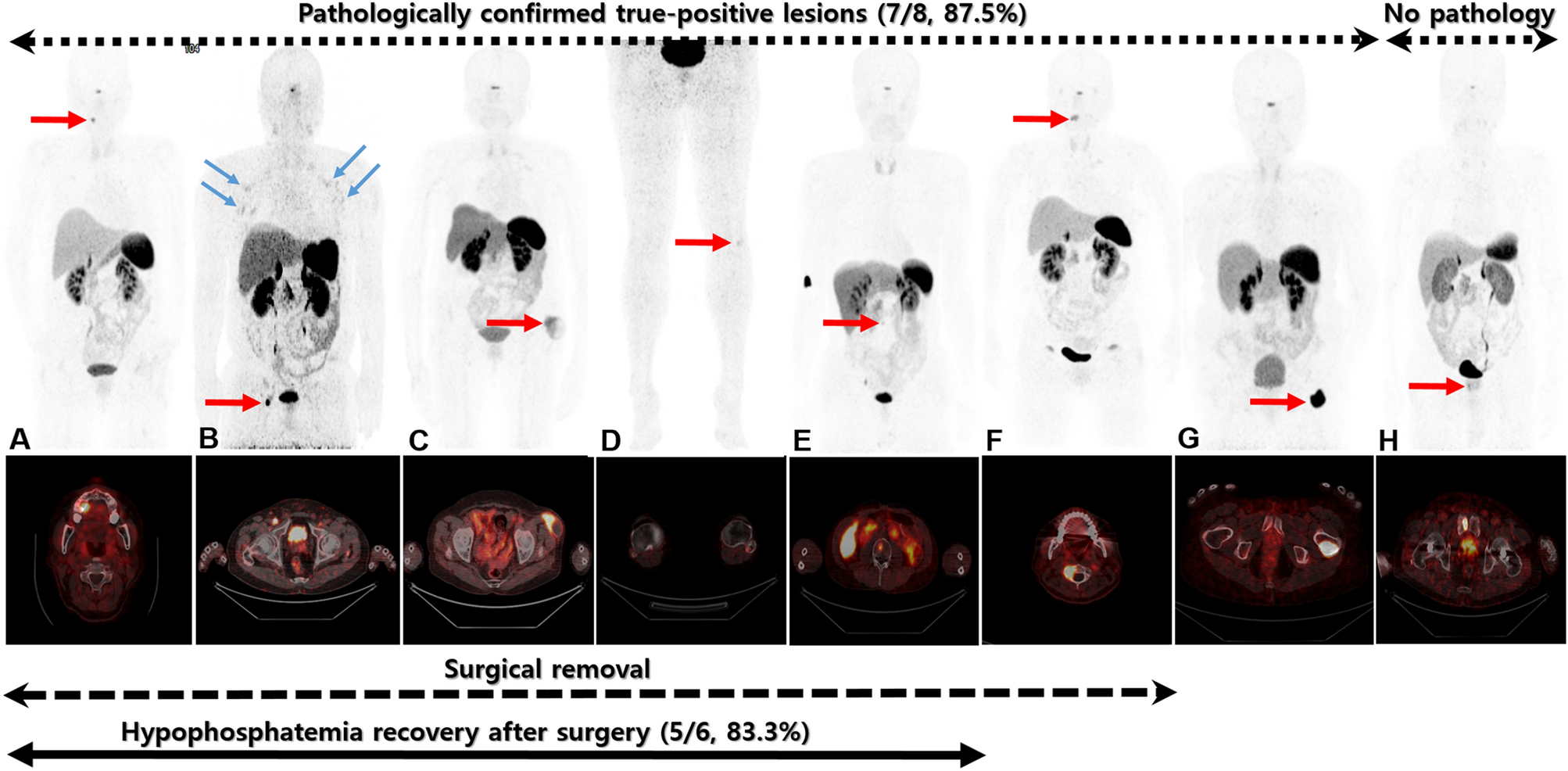 Usefulness of 68Ga-DOTATOC PET/CT to localize the culprit tumor inducing  osteomalacia | Scientific Reports