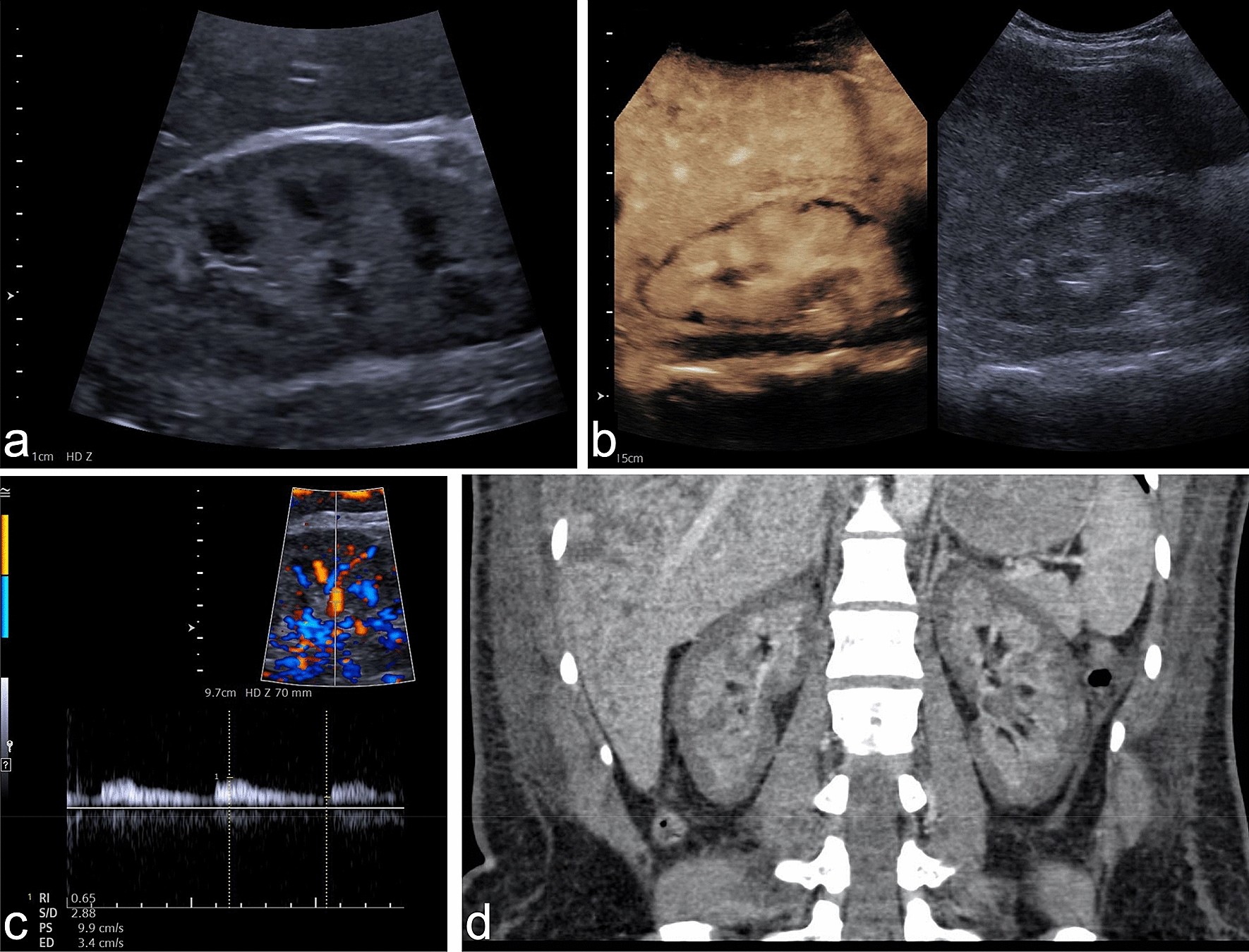Multiparametric ultrasound findings in acute kidney failure due to rare cortical necrosis Scientific Reports