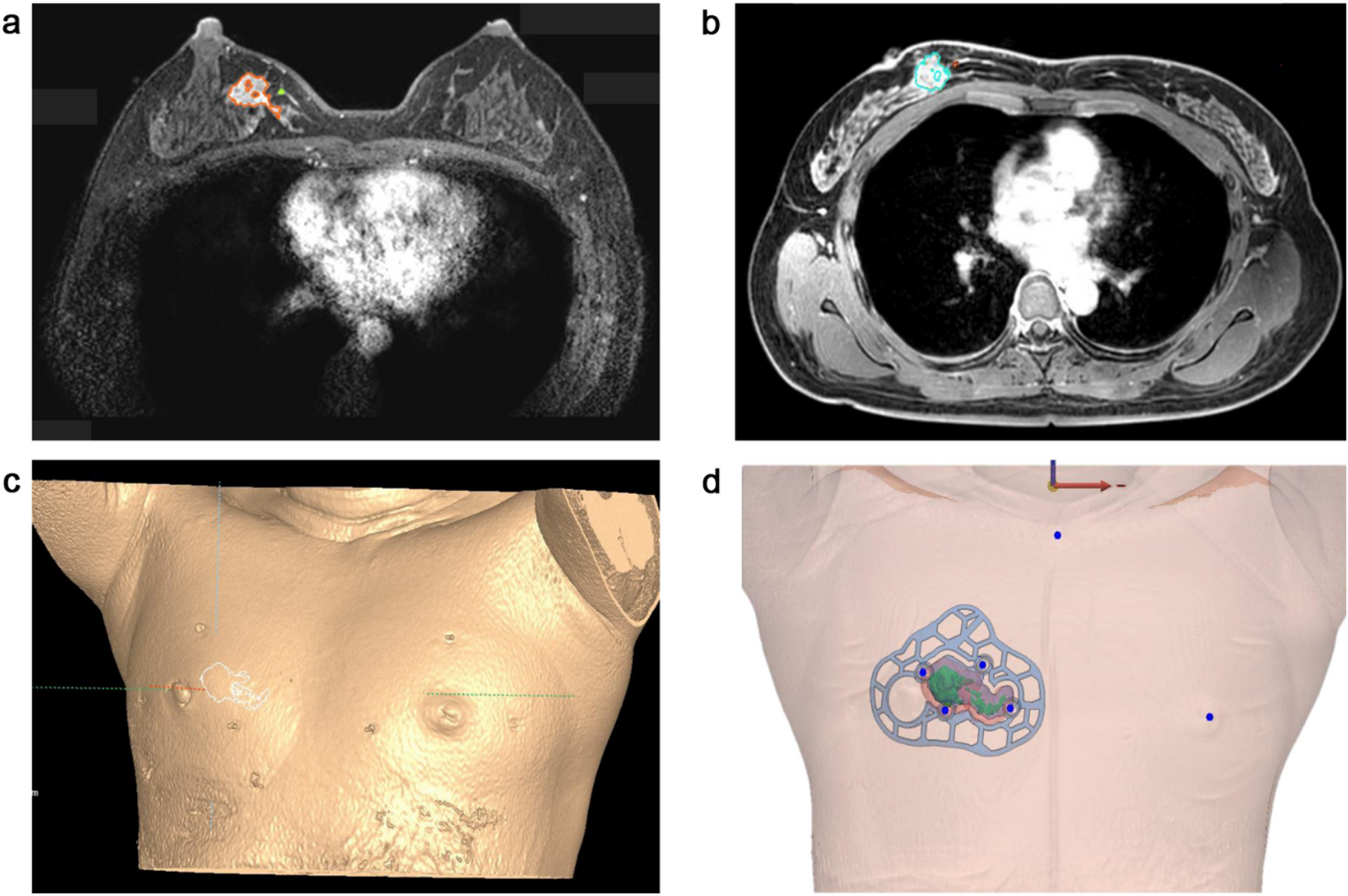 Breast-conserving surgery with 3D-printed surgical guide: a single-center,  prospective clinical study