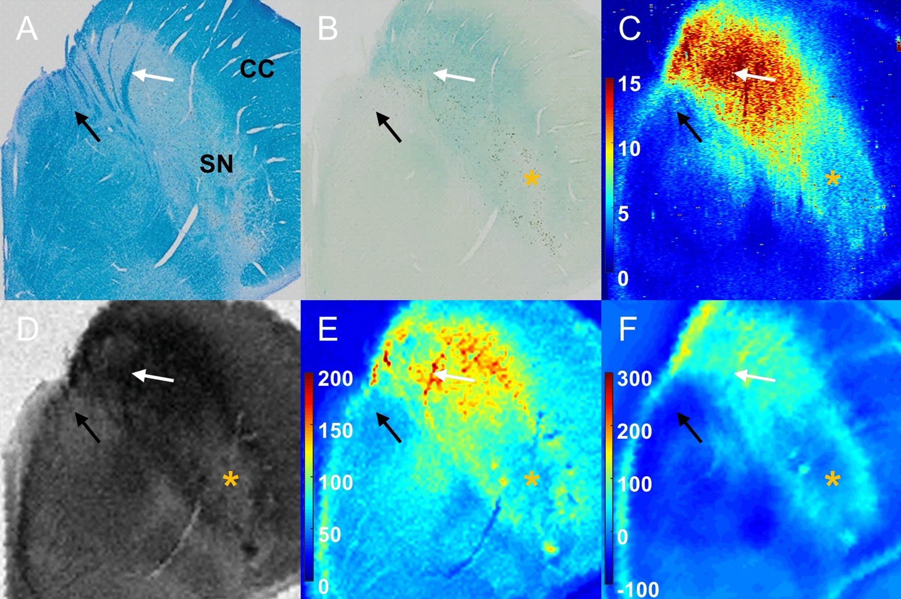 Iron accumulation in the oculomotor nerve of the progressive supranuclear  palsy brain | Scientific Reports