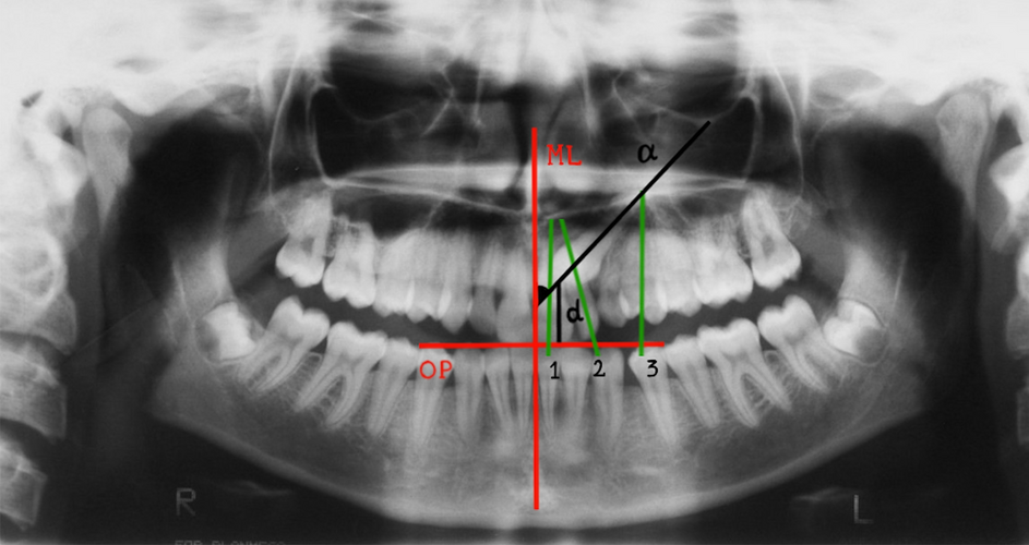 Comparison of dental anomalies between the groups with impacted