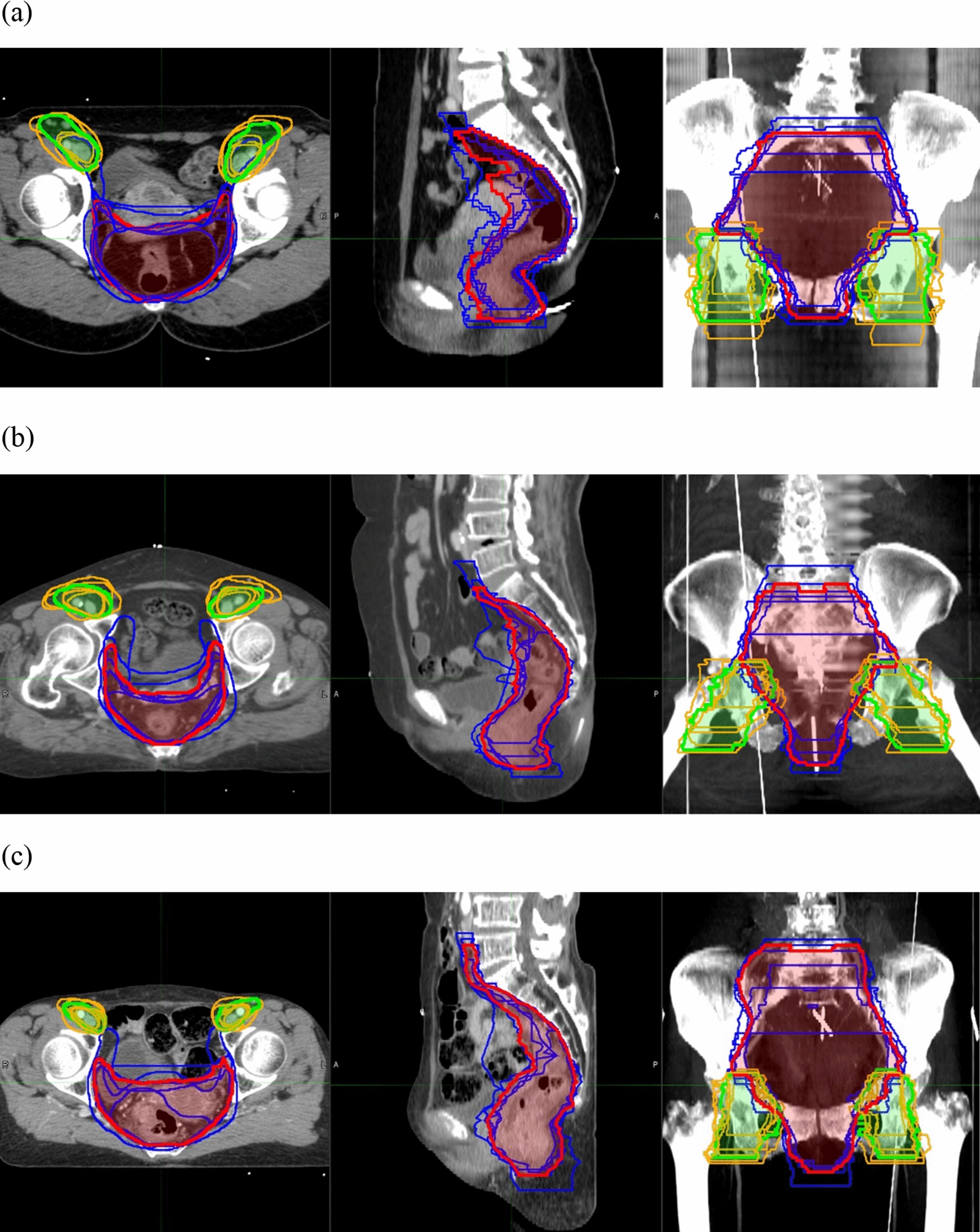 Interobserver variability in clinical target volume delineation in anal  squamous cell carcinoma | Scientific Reports
