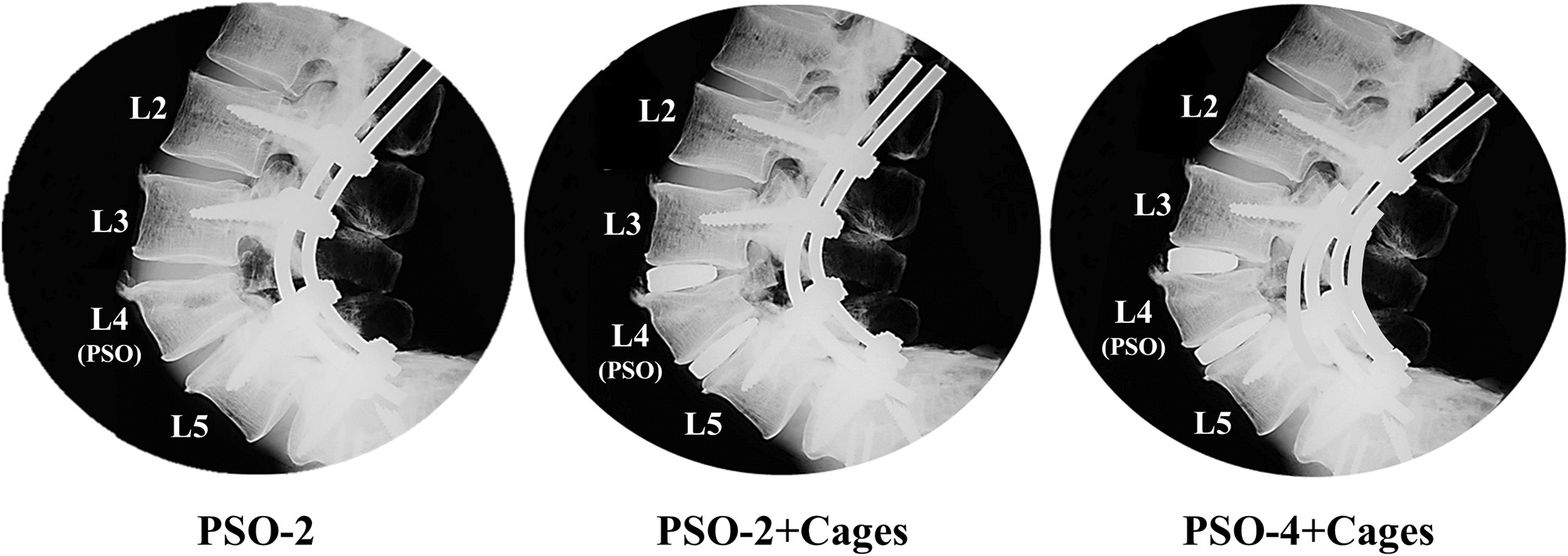 Load Sharing Biomechanics Of Lumbar Fixation And Fusion With Pedicle Subtraction Osteotomy Scientific Reports