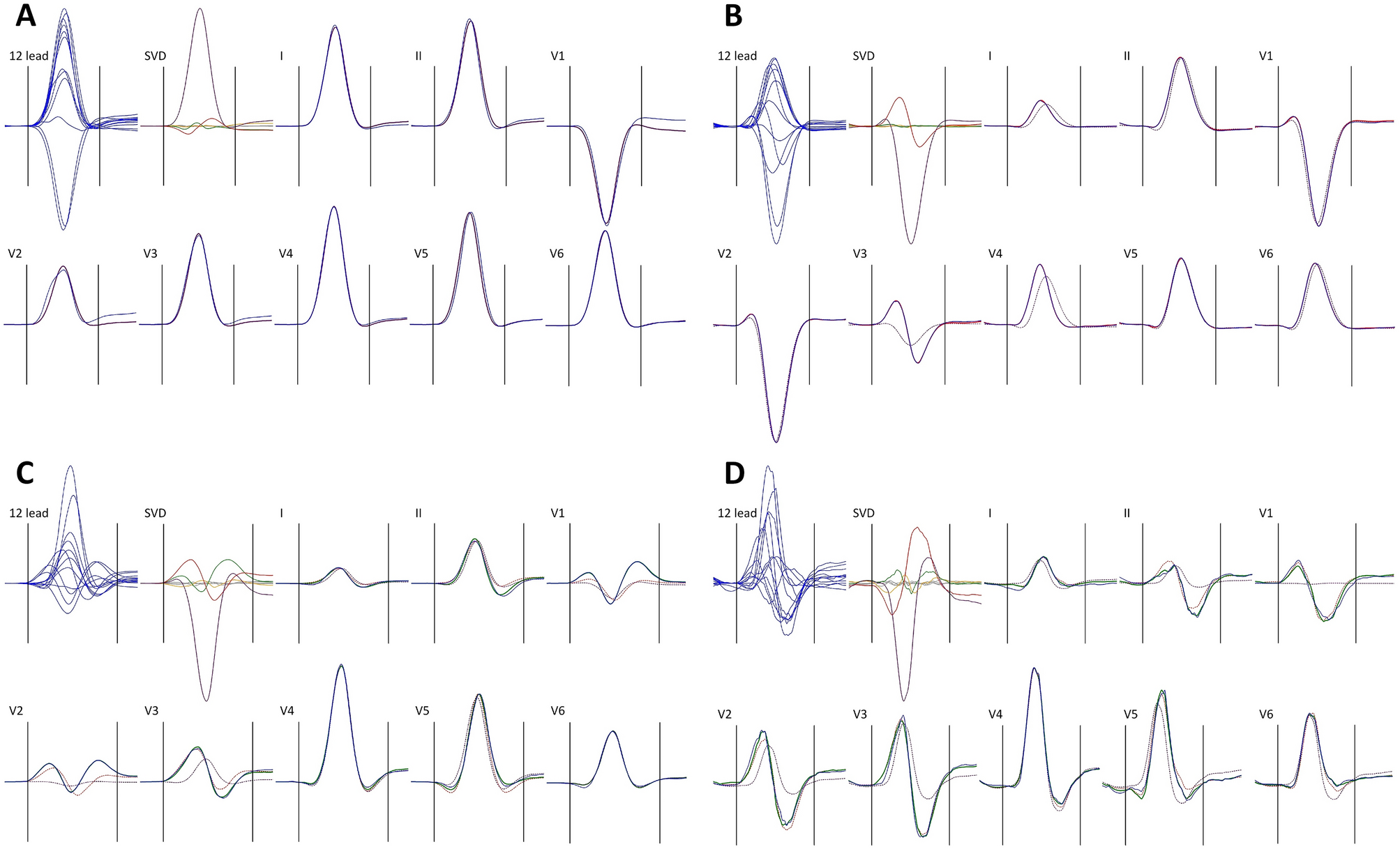 Spatial Distribution Of Physiologic 12 Lead Qrs Complex Scientific Reports