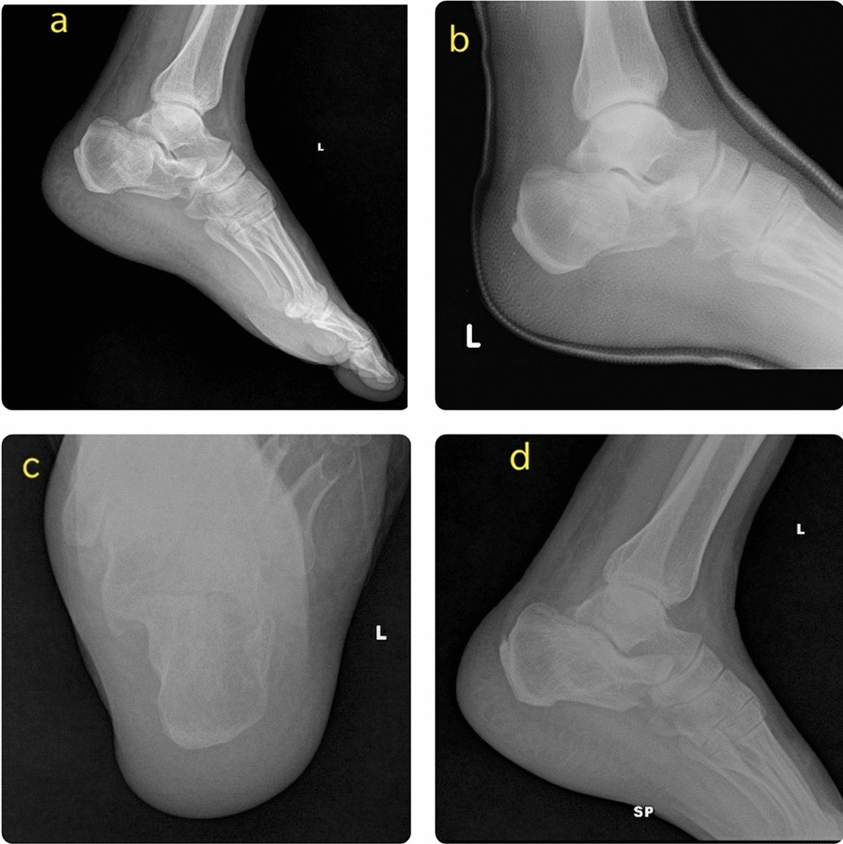 IJERPH | Free Full-Text | Surgical Treatment Using Sinus Tarsi Approach  with Anterolateral Fragment Open-Door Technique in Sanders Type 3 and 4  Displaced Intraarticular Calcaneal Fracture
