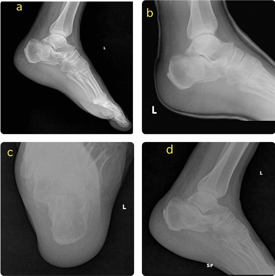 Avulsion Styloid Process Fractures Causes & Treatment – My FootDr