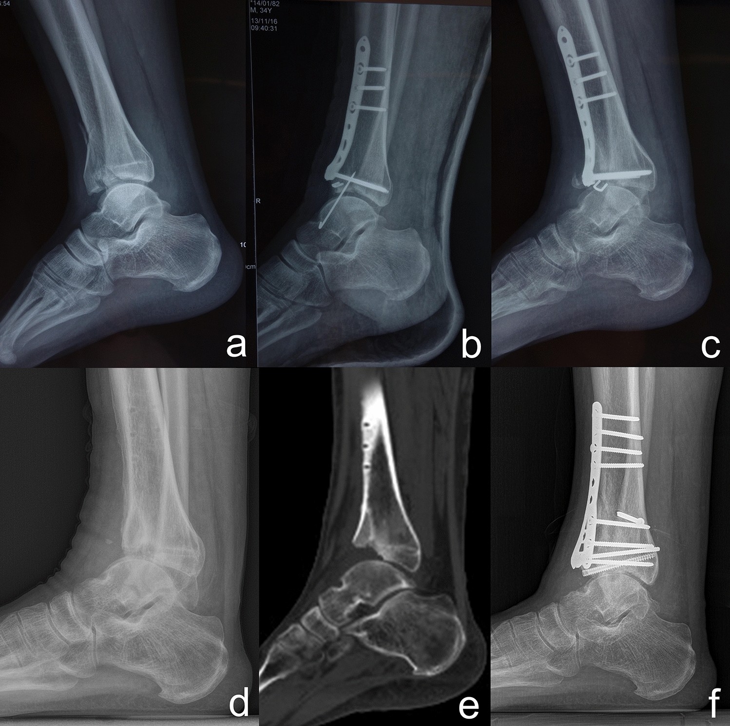 Patient with tibia nonunion. a X-ray from the pre-treatment period