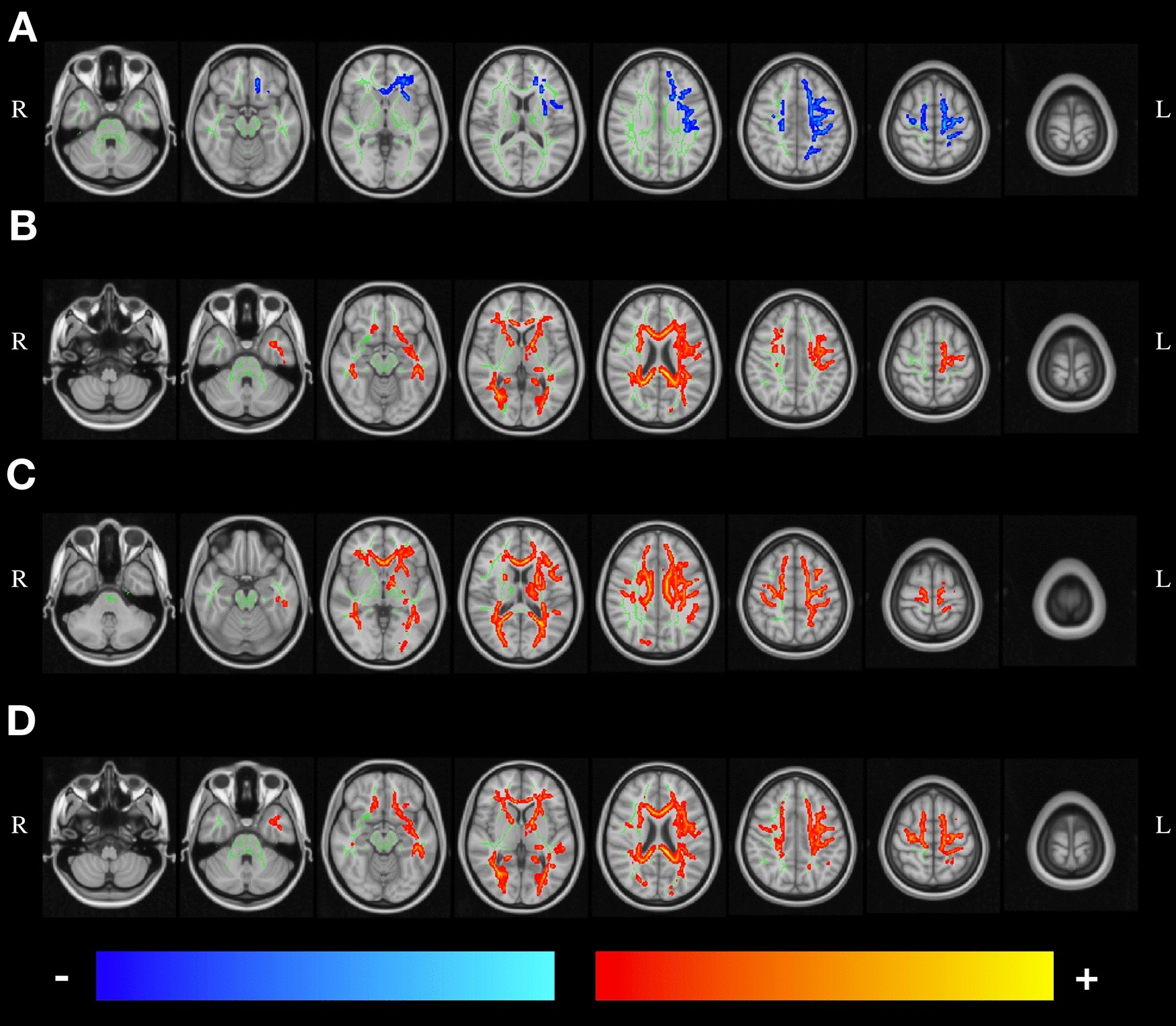 Signatures of white-matter microstructure degradation during aging and its  association with cognitive status | Scientific Reports
