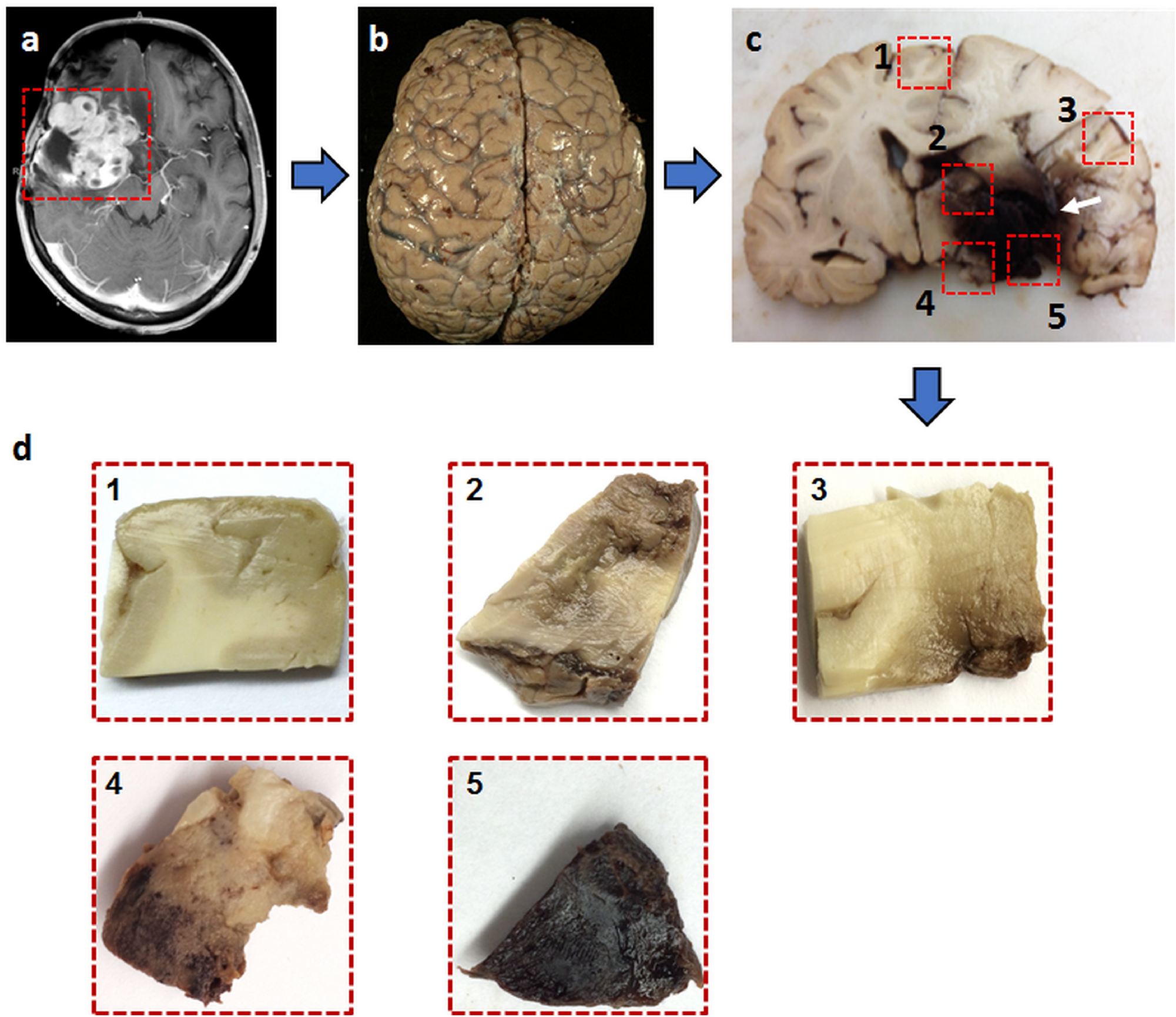 Diffusion histology imaging differentiates distinct pediatric brain tumor  histology | Scientific Reports