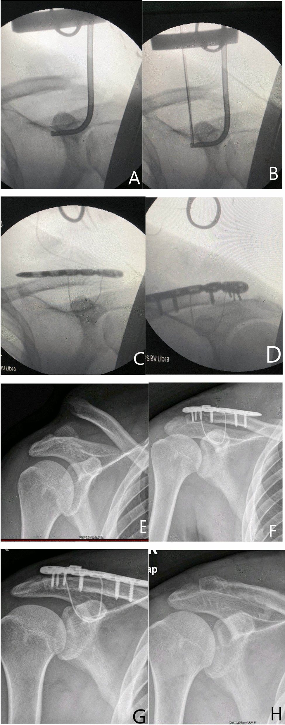 Treatment of distal clavicle fracture of Neer type II with locking plate in  combination with titanium cable under the guide | Scientific Reports