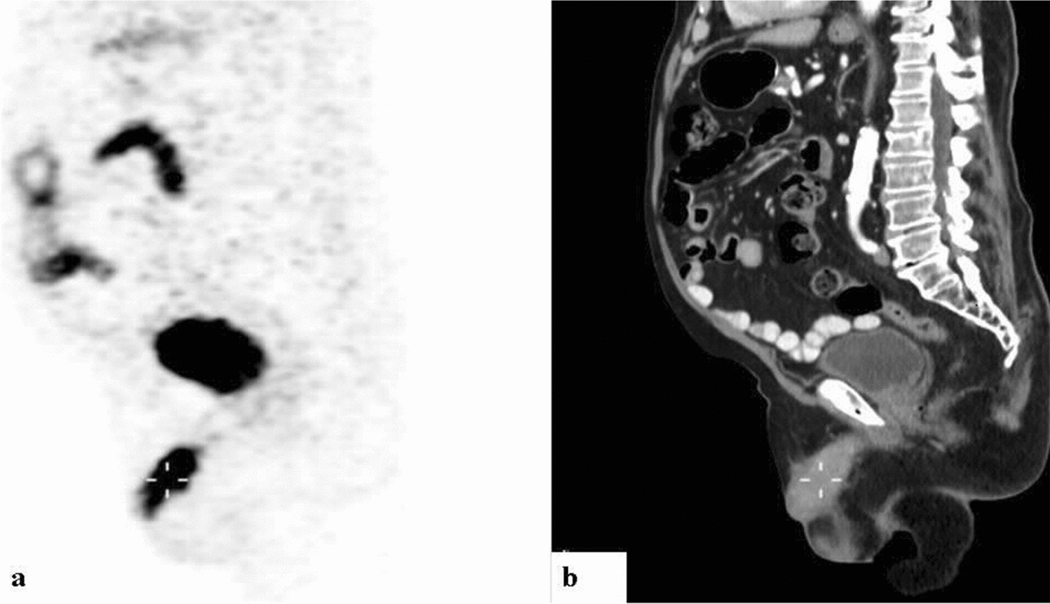 Penile secondary lesions: a rare entity detected by PET/CT | Scientific  Reports
