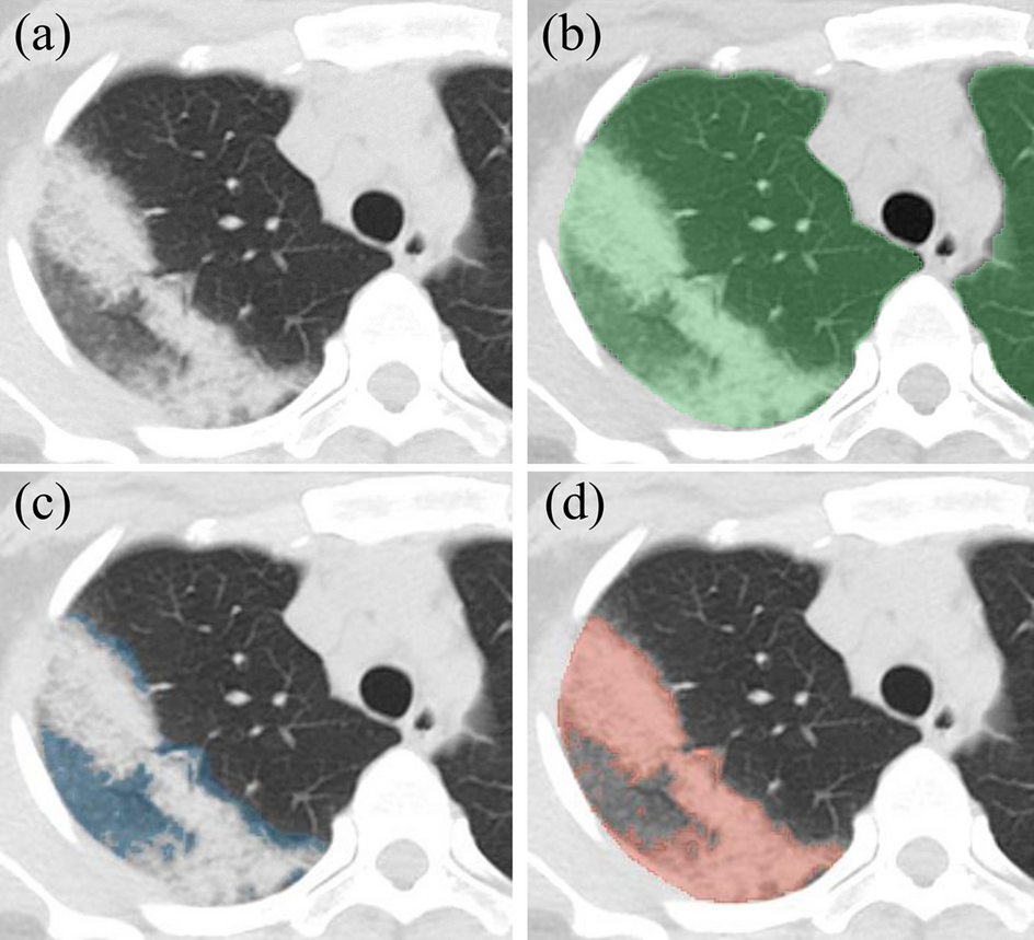 chest CT and lab curves throughout the course COVID-19 | Scientific Reports