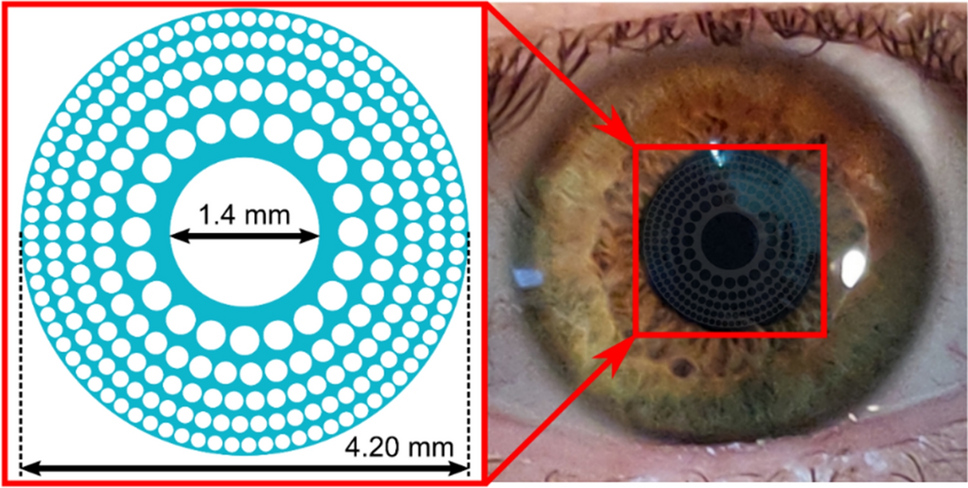 A new trifocal corneal inlay for presbyopia | Scientific Reports