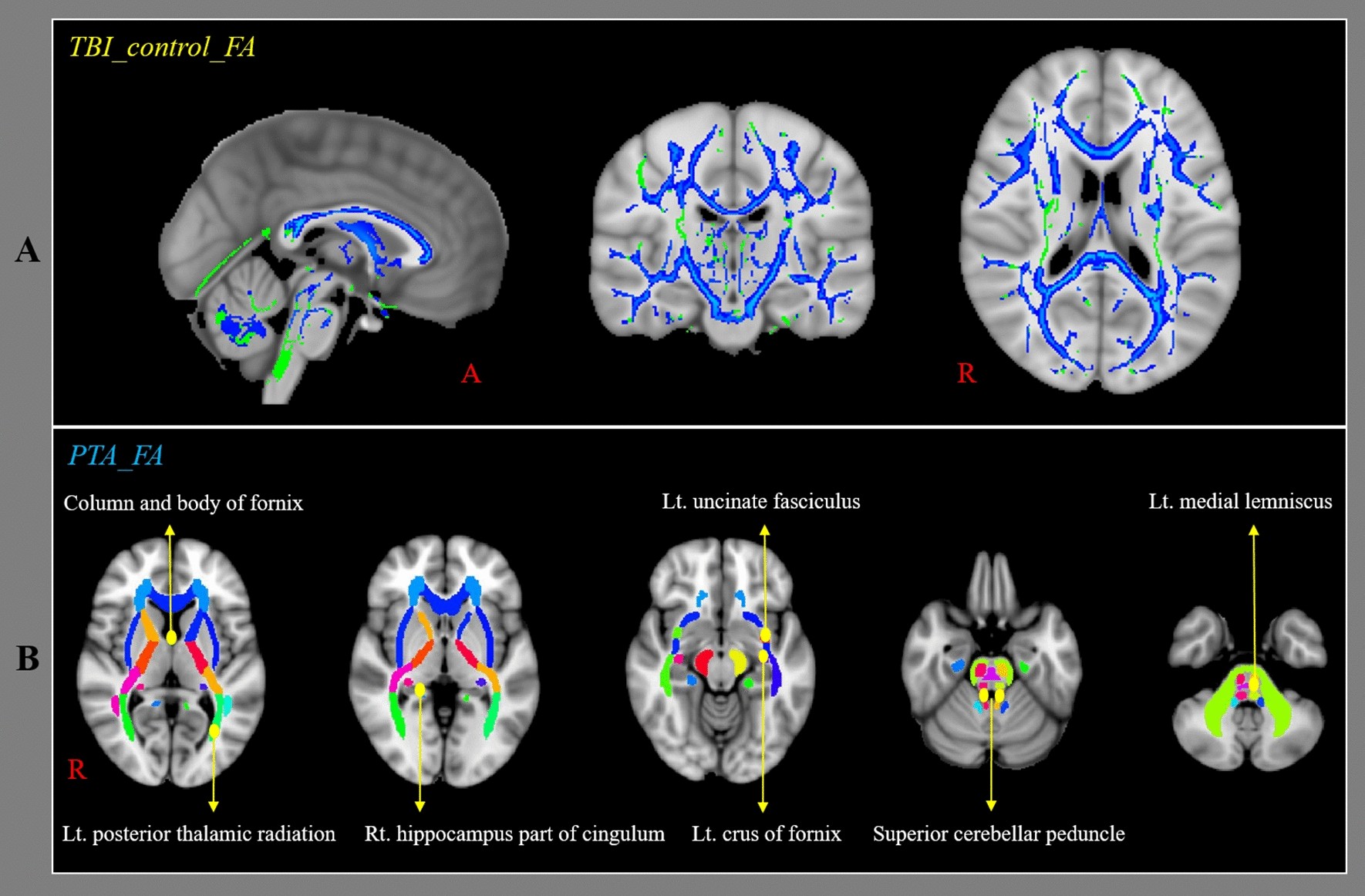 Diffusion Tensor Imaging in Traumatic Brain Injury