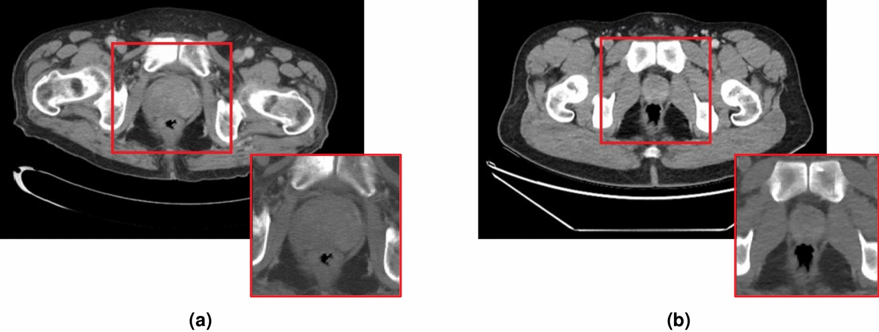 Incidental of prostate cancer with computed tomography scans | Scientific Reports