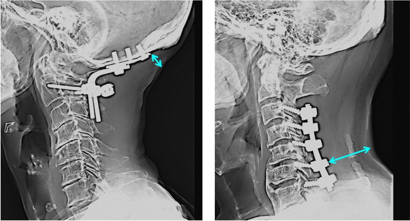Risk factors for deep surgical site infection after posterior cervical spine  surgery in adults: a multicentre observational cohort study