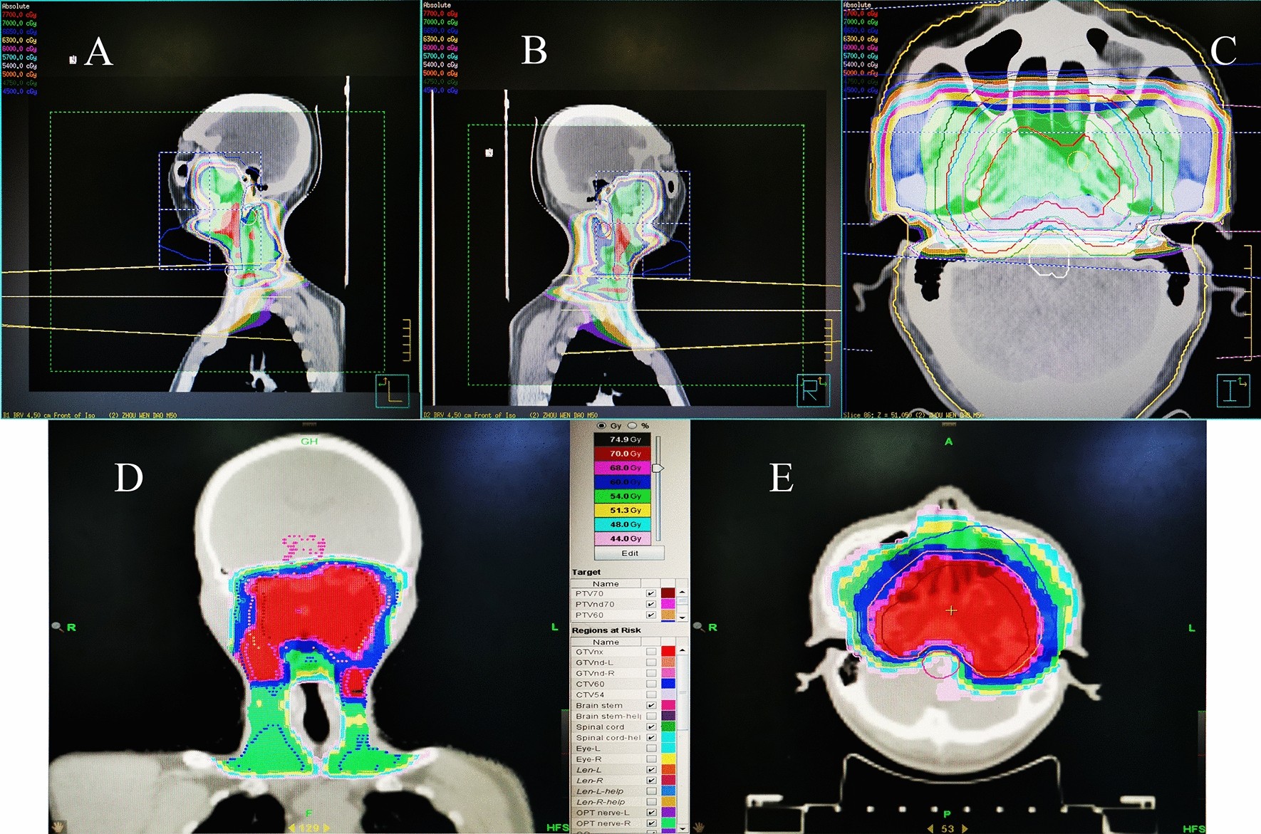 Radiation-induced acute injury of intensity-modulated radiotherapy versus  three-dimensional conformal radiotherapy in induction chemotherapy followed  by concurrent chemoradiotherapy for locoregionally advanced nasopharyngeal  carcinoma: a prospective ...