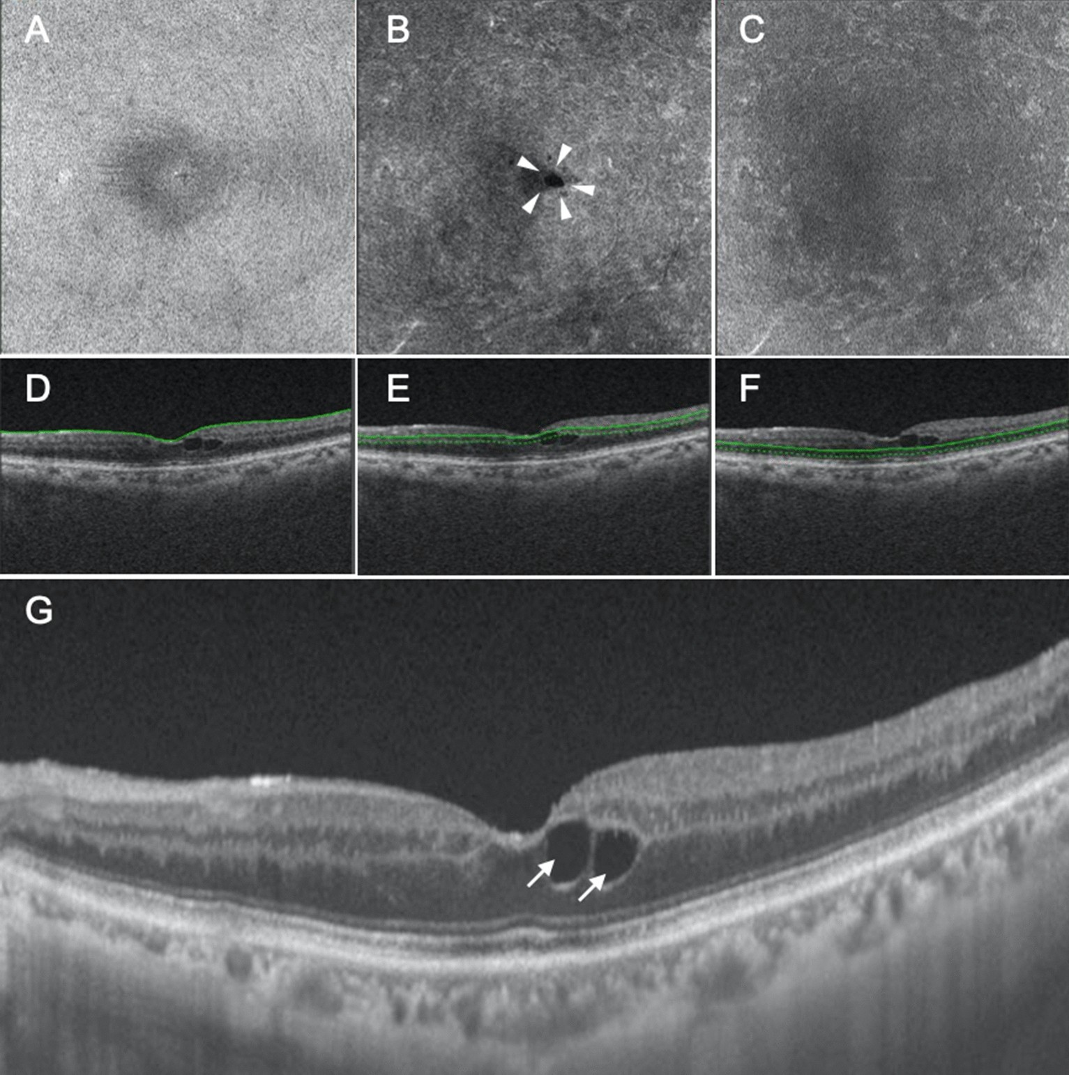 En face image-based classification of diabetic macular edema using swept  source optical coherence tomography | Scientific Reports