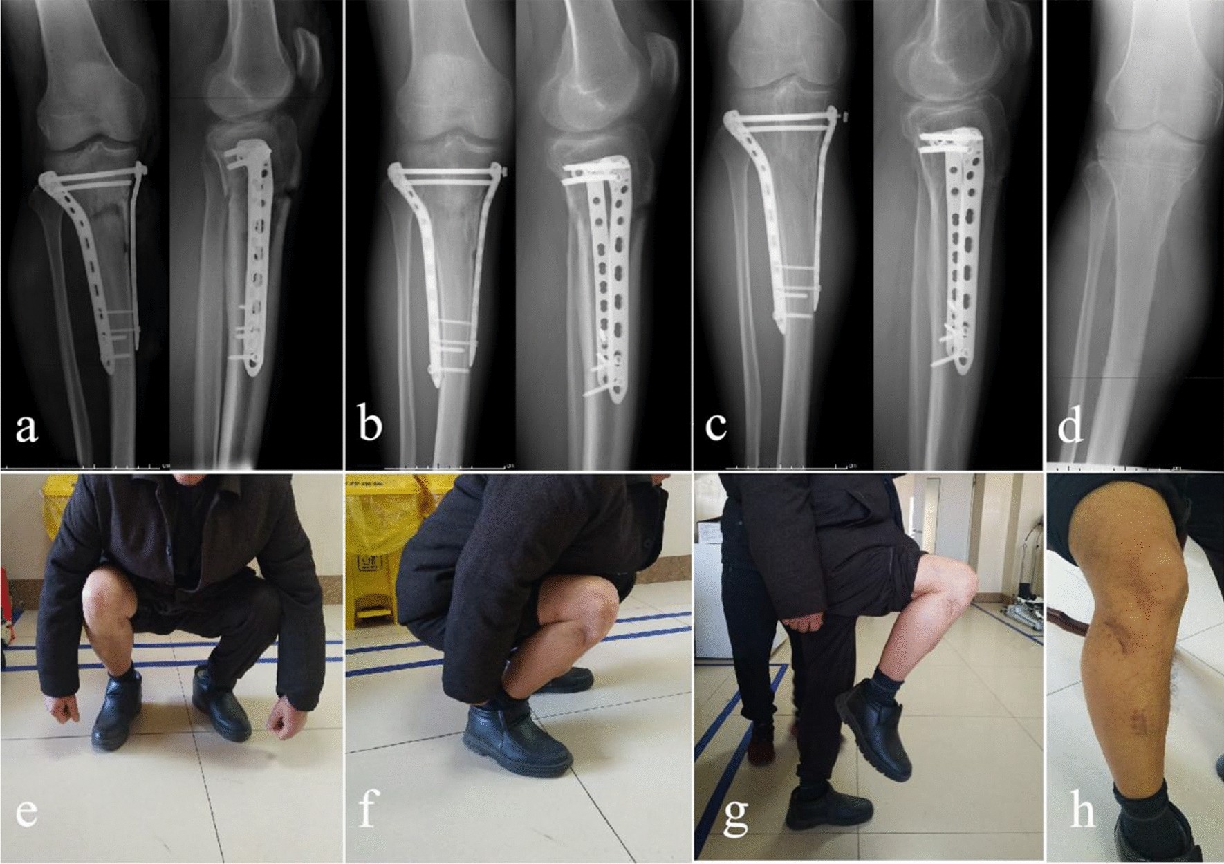 Dual plating or dual plating combined with compression bolts for bicondylar tibial  plateau fractures: a retrospective comparative study | Scientific Reports