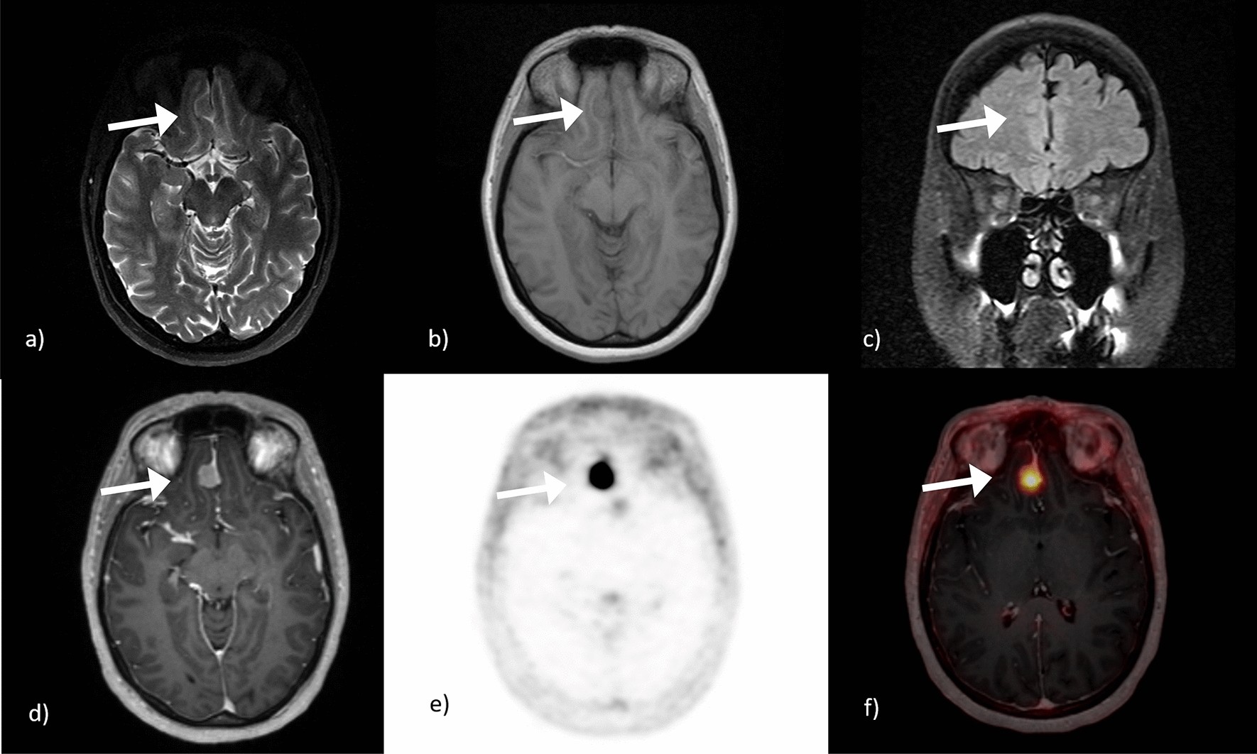 Comparison of diagnostic value of 68 Ga-DOTATOC PET/MRI and standalone MRI  for the detection of intracranial meningiomas | Scientific Reports