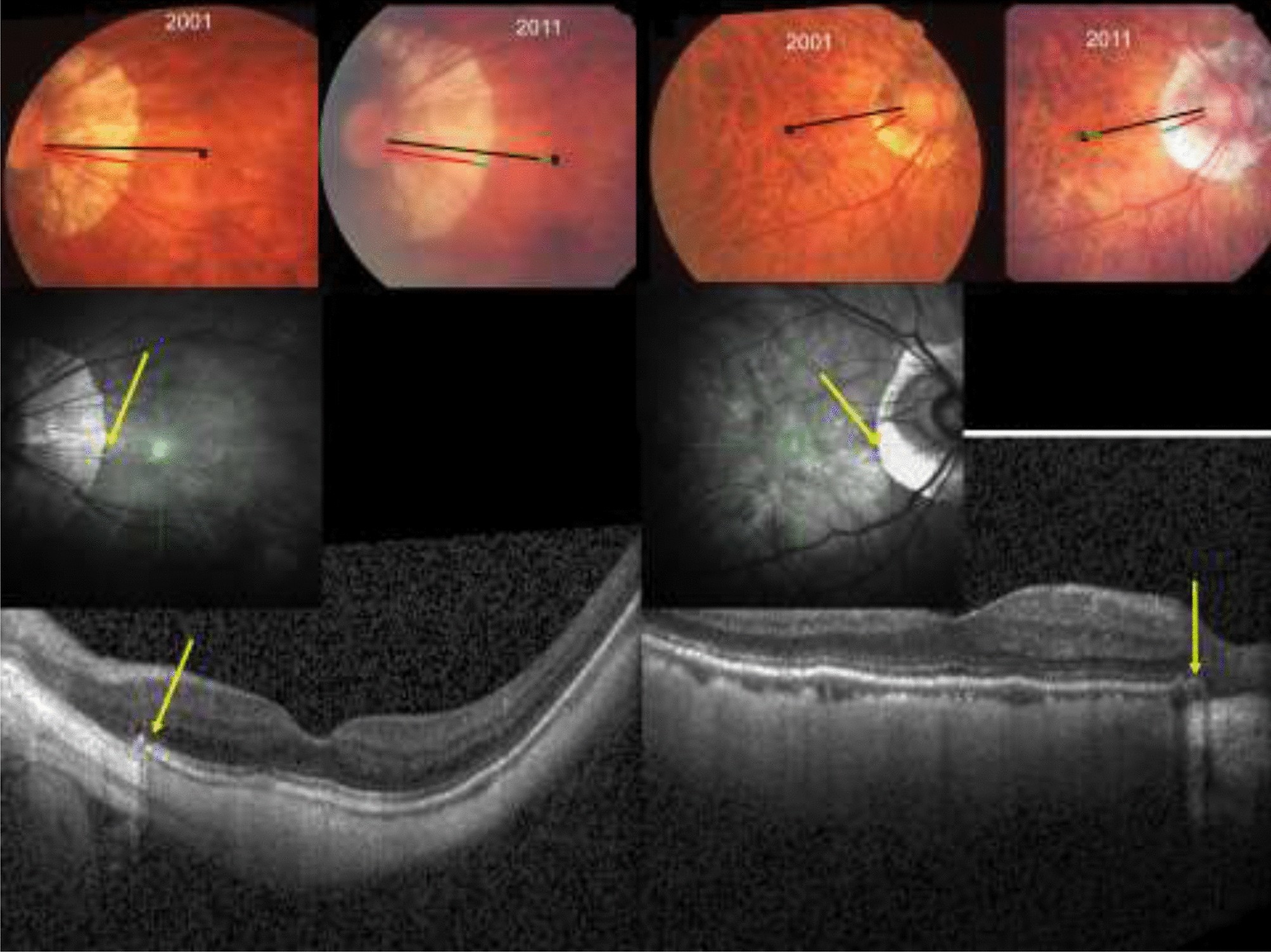 myopia retinal deformation