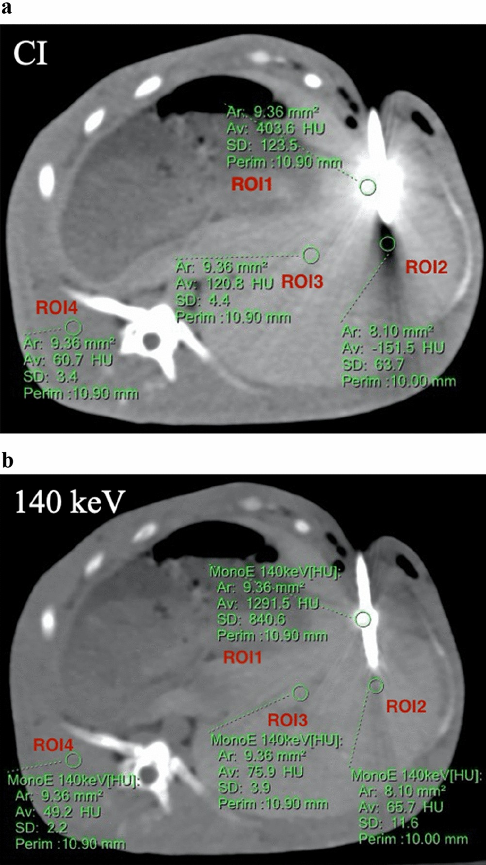 Reduction of microwave ablation needle related metallic artifacts using  virtual monoenergetic images from dual-layer detector spectral CT in a  rabbit model with VX2 tumor | Scientific Reports