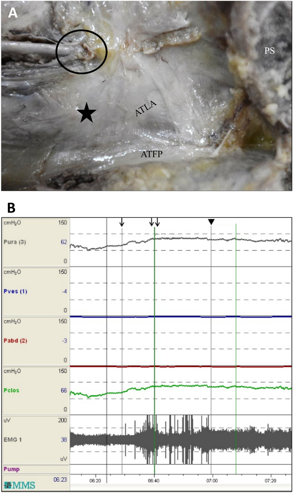 Attachment of the levator ani muscle extends to the superior ramus of the  pubic bone through electrophysiological and anatomical examinations |  Scientific Reports