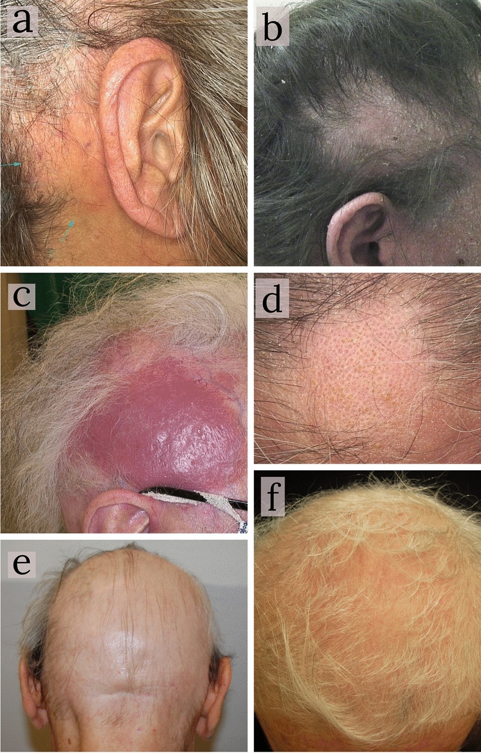Clinical and trichoscopic features in 18 cases of Folliculotropic Mycosis  Fungoides with scalp involvement | Scientific Reports