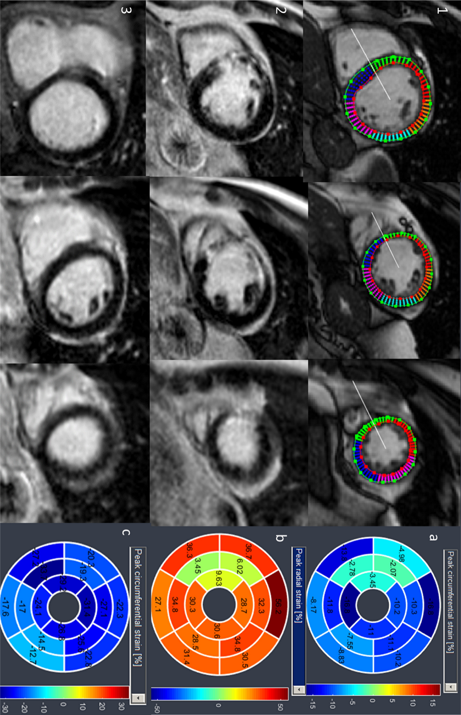 Myocardial strain assessed by feature tracking cardiac magnetic resonance  in patients with a variety of cardiovascular diseases – A comparison with  echocardiography