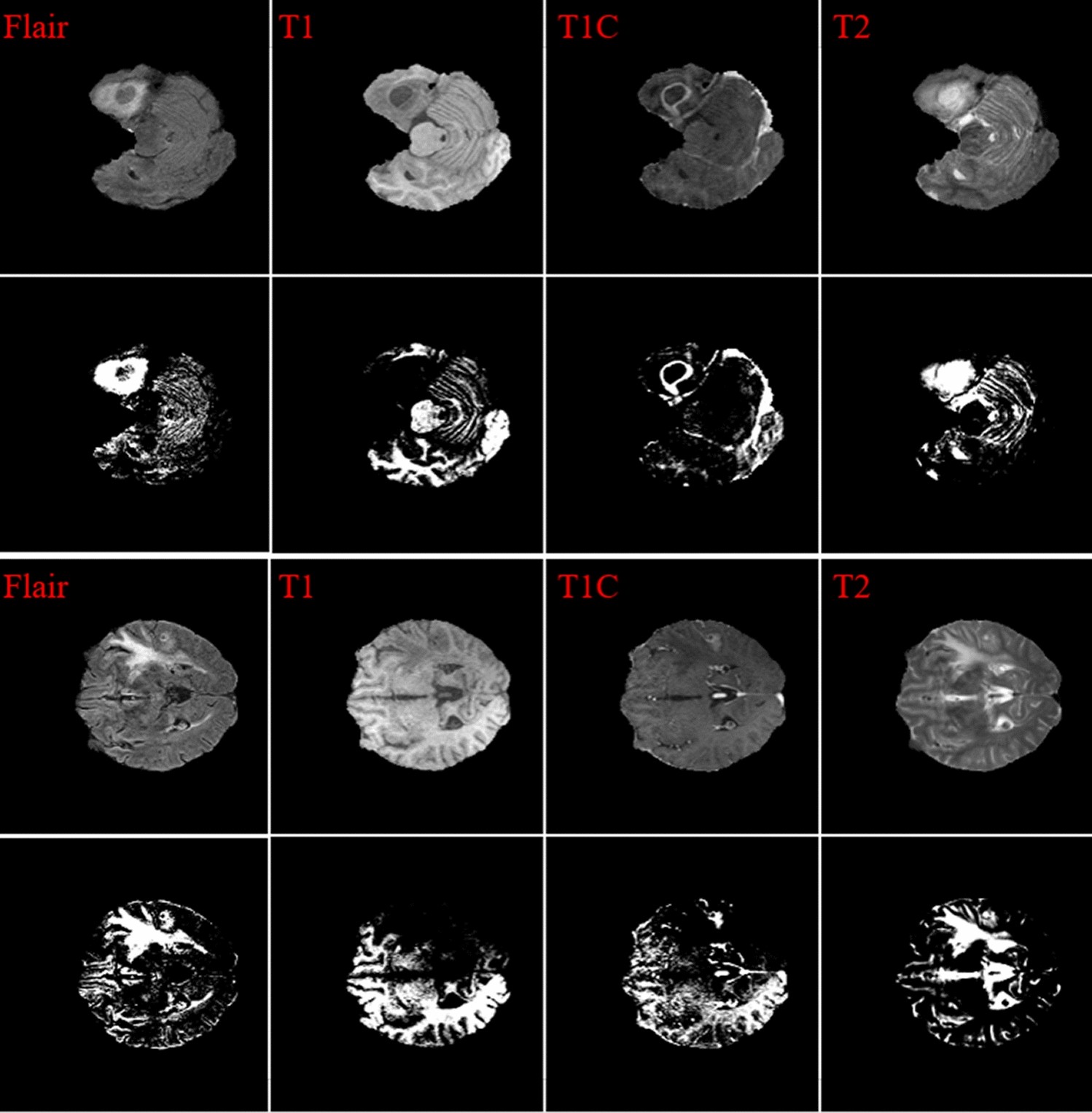 Brain tumor segmentation based on deep learning and an attention mechanism  using MRI multi-modalities brain images