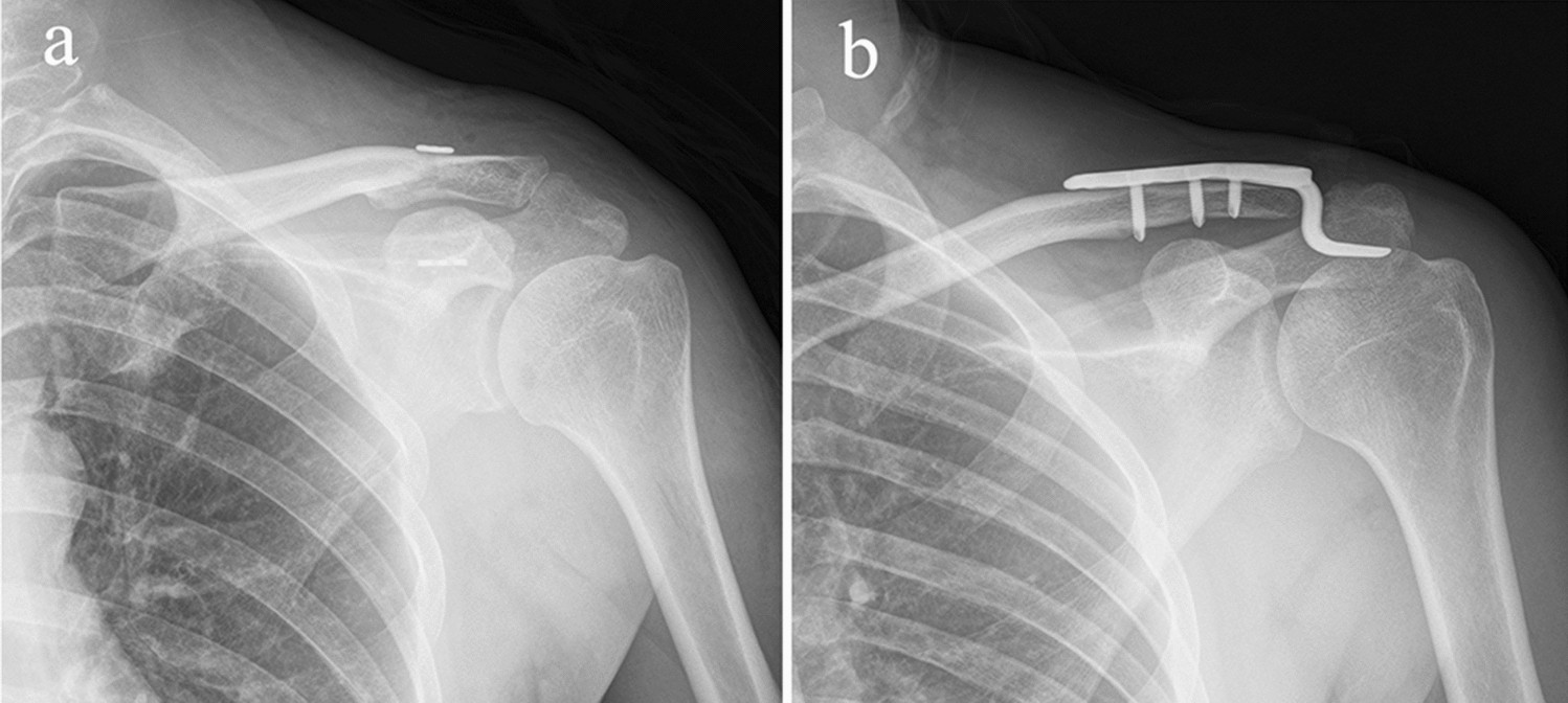 Comparison of the TightRope system versus hook plate in acute acromioclavicular joint dislocations: a retrospective | Scientific Reports