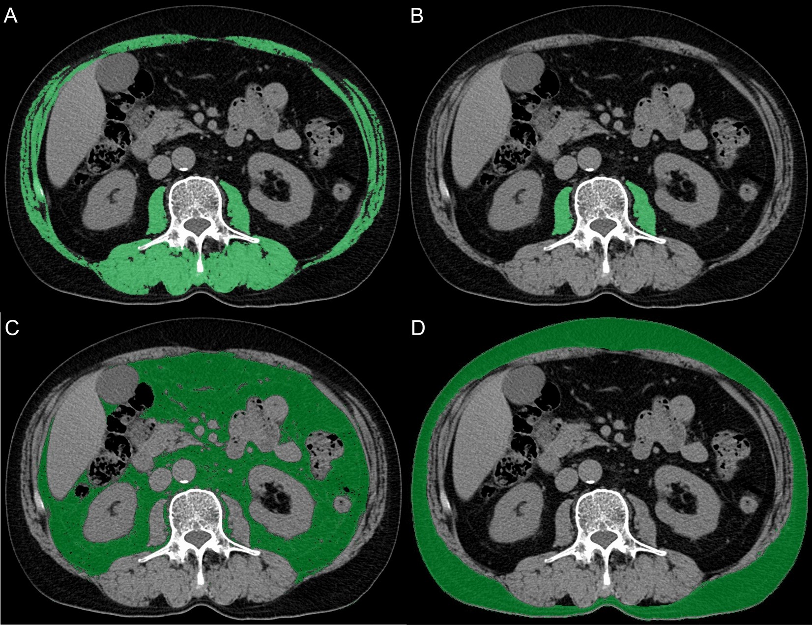 Impact of Sarcopenia on Outcomes Following Resection of Pancreatic Adenocarcinoma