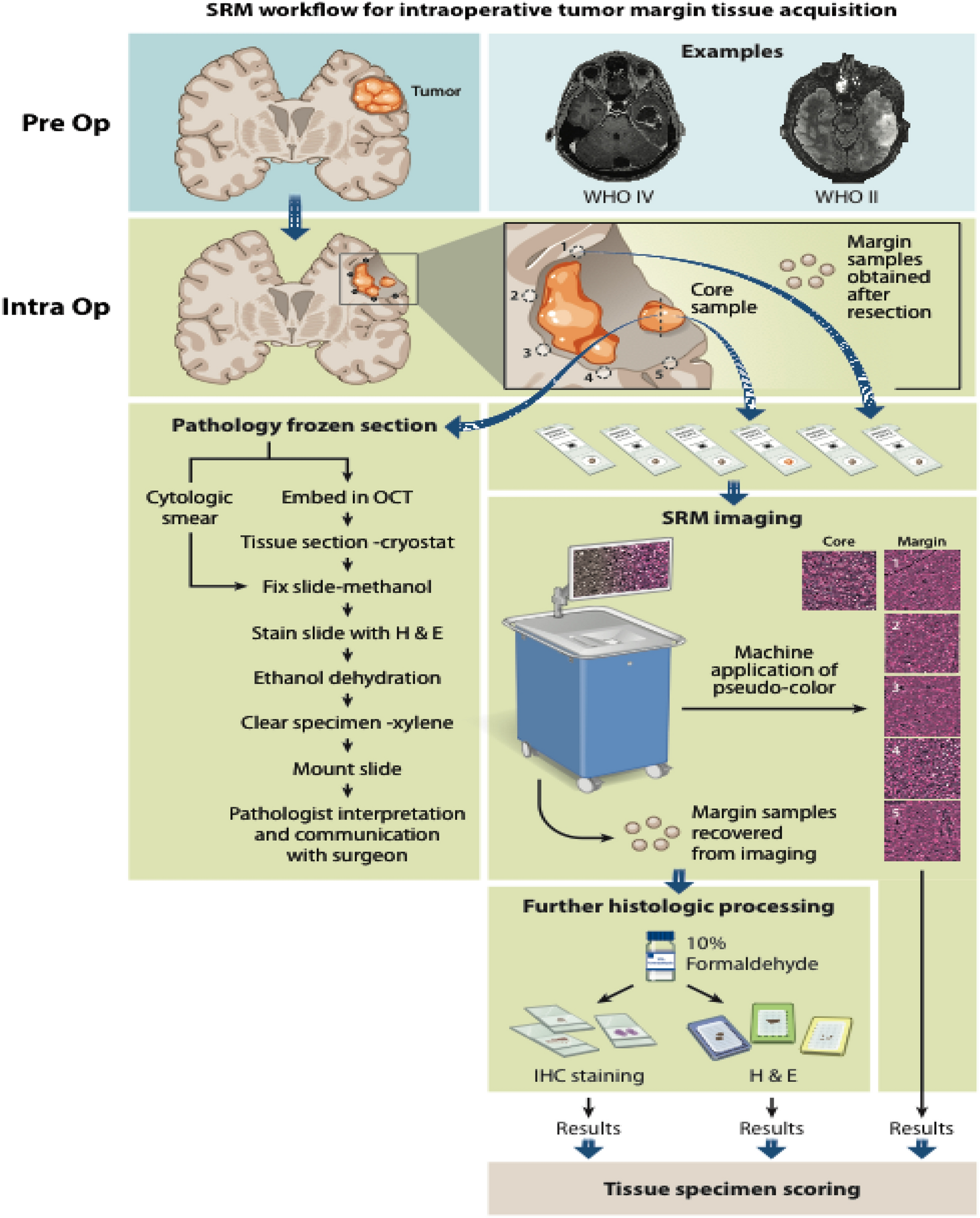 Detection of glioma infiltration at the tumor margin using quantitative  stimulated Raman scattering histology | Scientific Reports