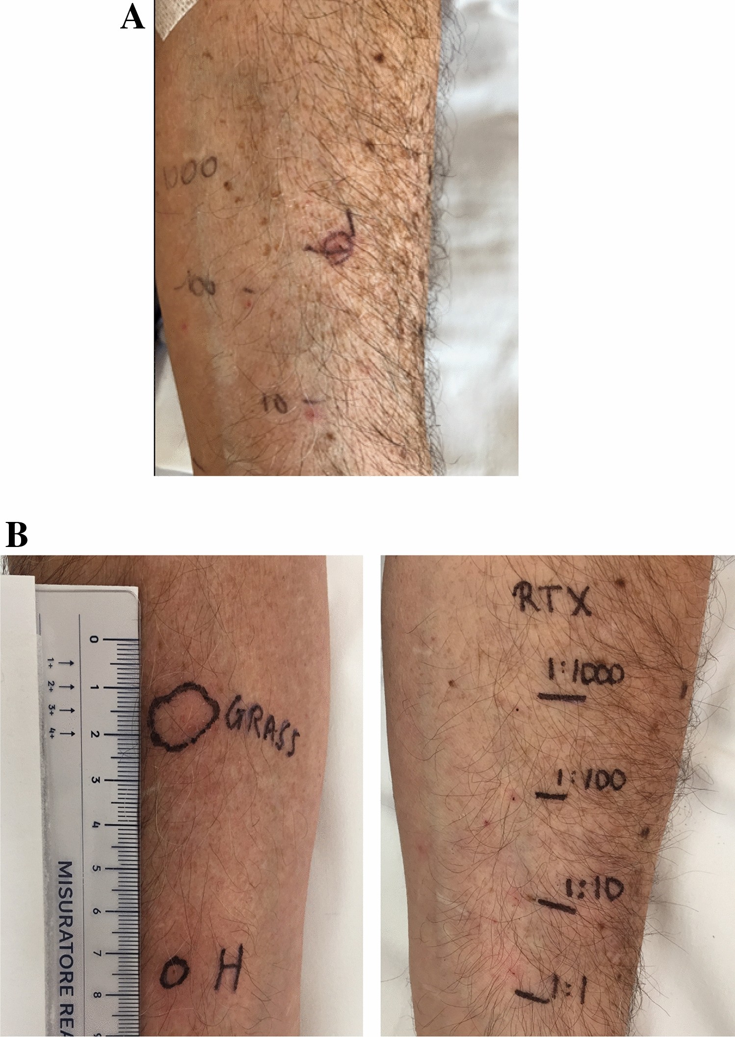 Drug Specific Treg Cells Are Induced During Desensitization Procedure For Rituximab And Tocilizumab In Patients With Anaphylaxis Scientific Reports