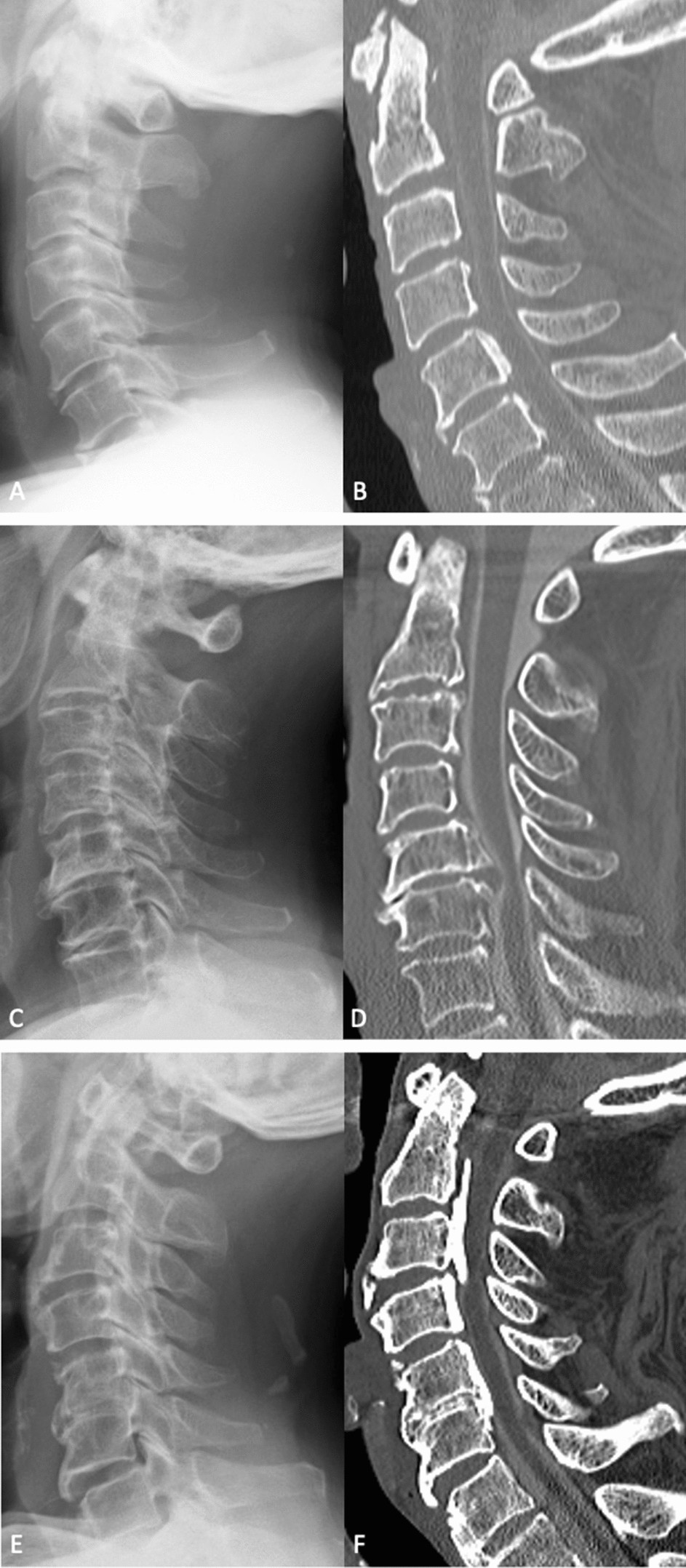 Spine Spine