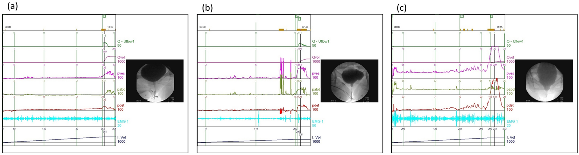 Therapeutic efficacy of biofeedback pelvic floor muscle exercise in women  with dysfunctional voiding