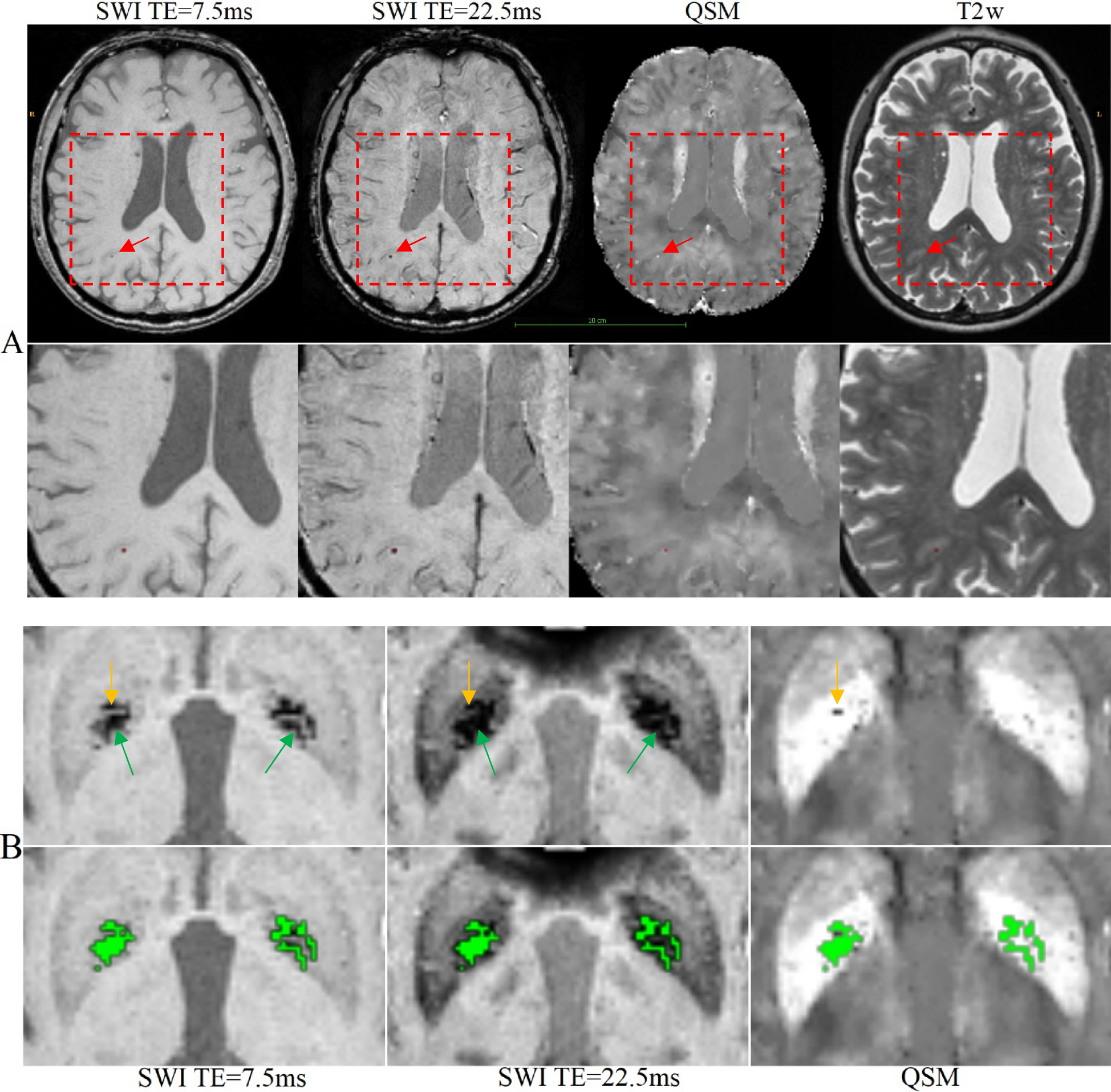 Magnetic resonance imaging. Large intracranial hemorrhage with moderate