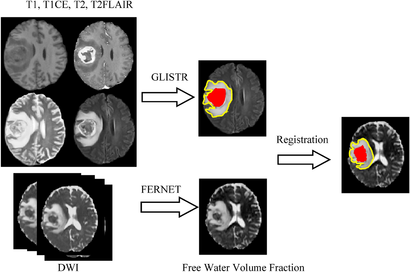 Automated detection of brain metastases on non-enhanced CT using