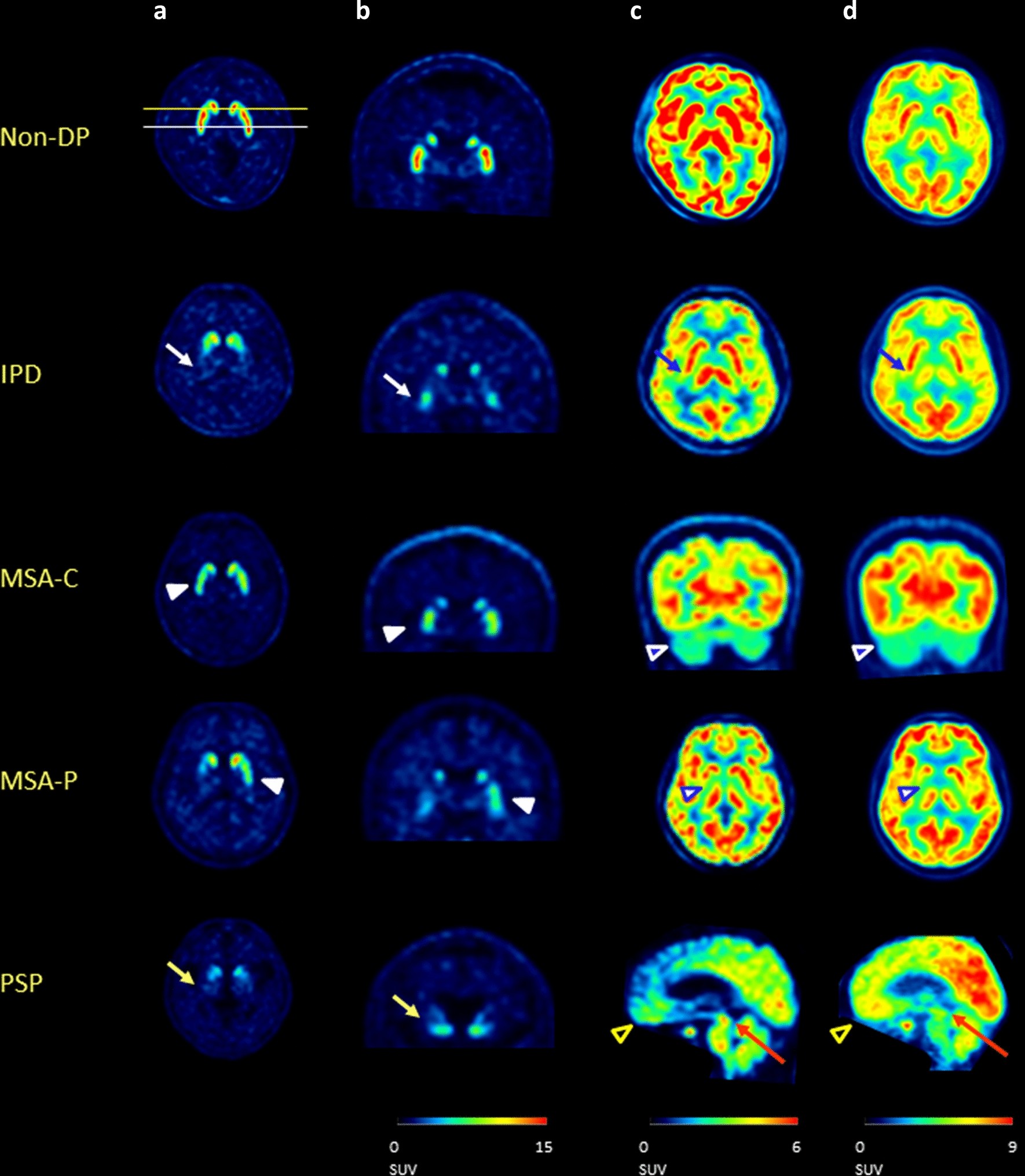 Diagnostic accuracy of dual-phase 18F-FP-CIT PET imaging for detection and  differential diagnosis of Parkinsonism | Scientific Reports