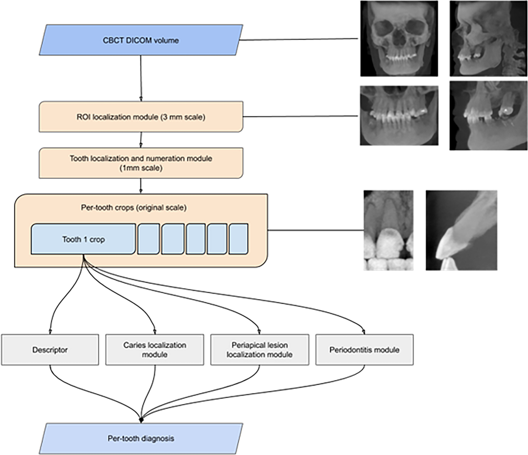 3D reconstructions showing microcracks in the mesial roots of