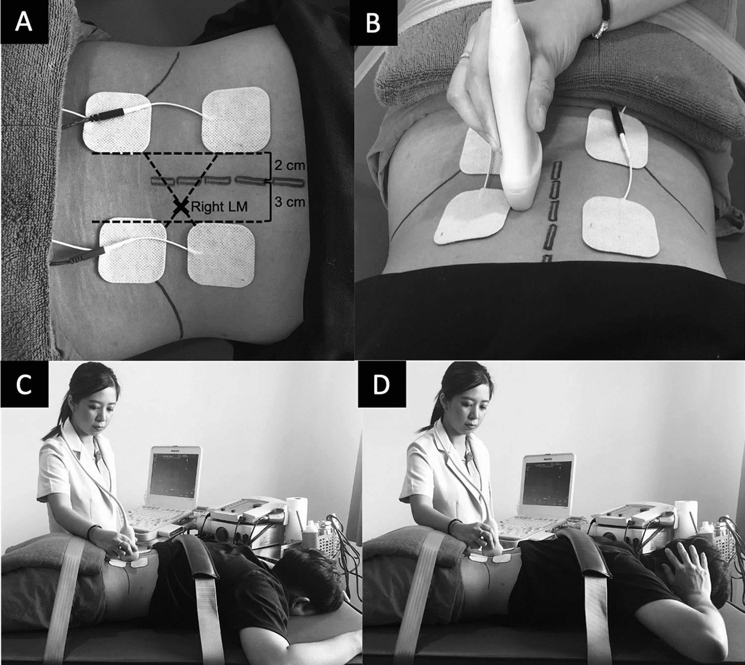 Combined neuromuscular electrical stimulation with motor control exercise  can improve lumbar multifidus activation in individuals with recurrent low back  pain